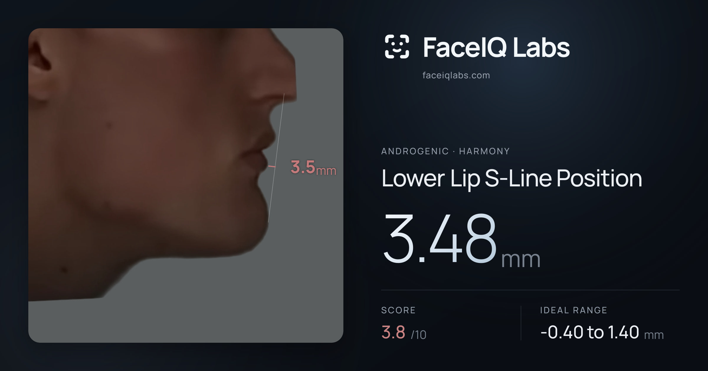 Androgenic Lower Lip S-Line Position: 3.48mm, drawn on the photo