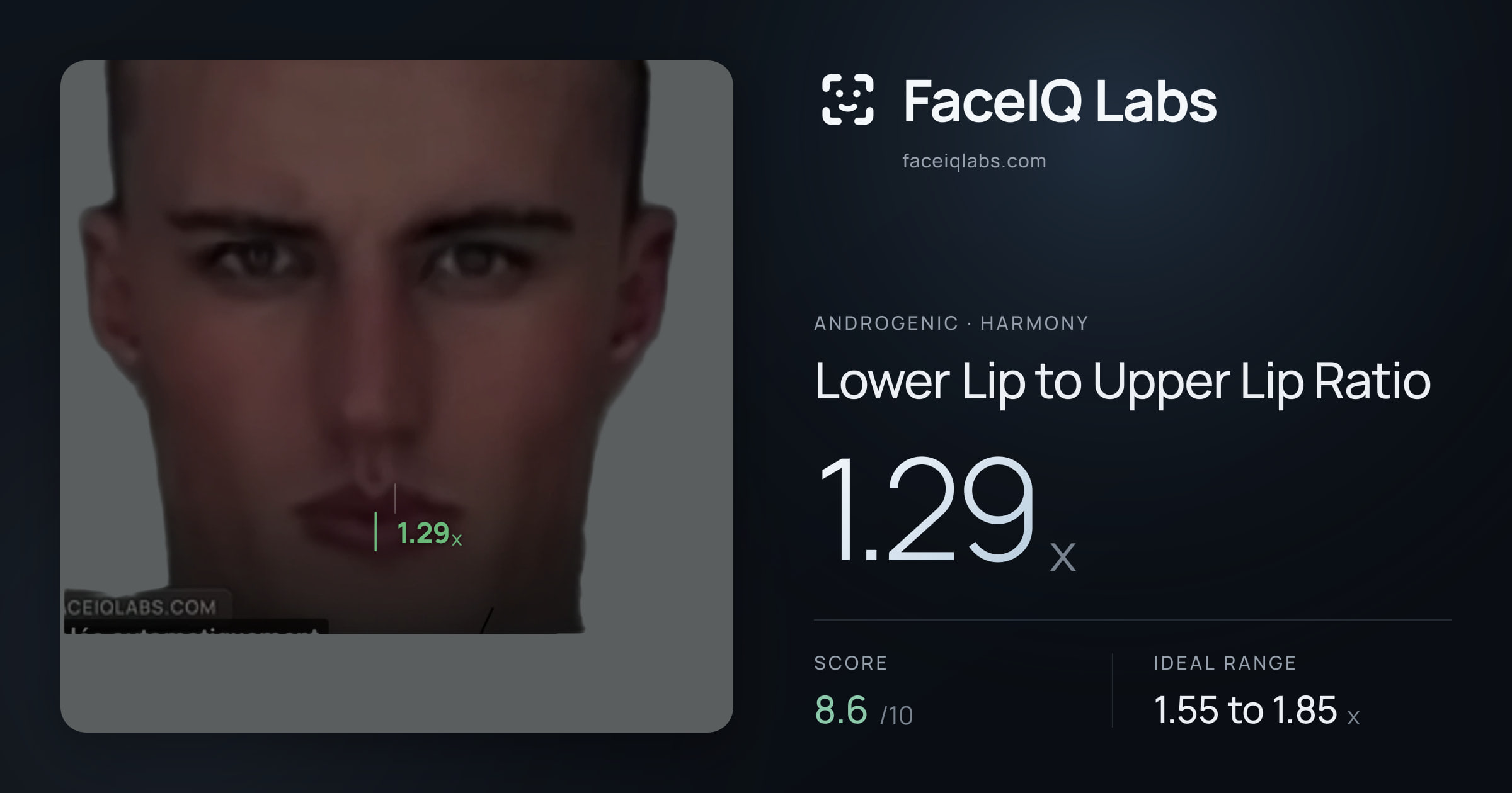 Androgenic Lower Lip to Upper Lip Ratio: 1.29x, drawn on the photo