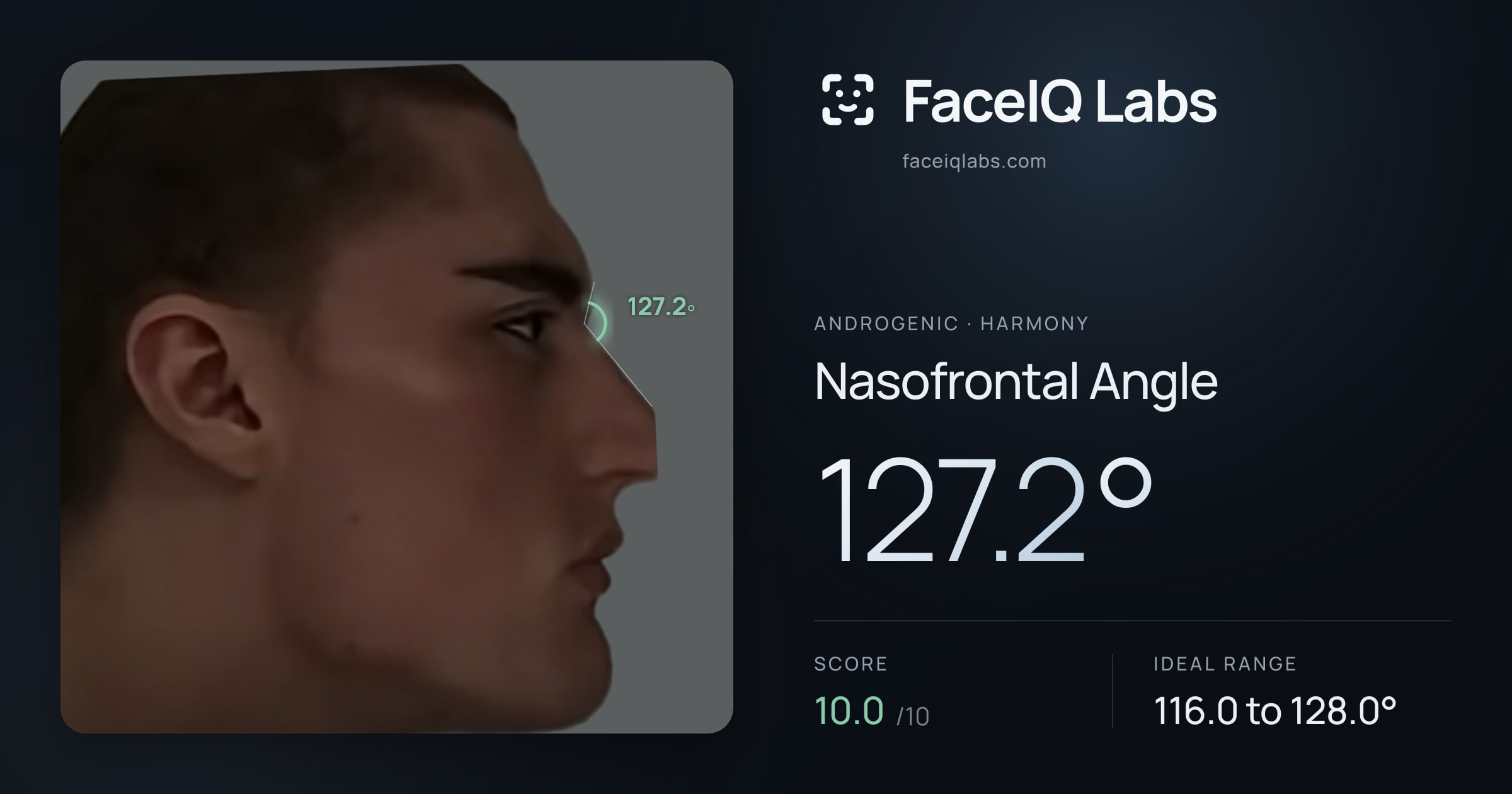 Androgenic Nasofrontal Angle: 137.2°, drawn on the photo