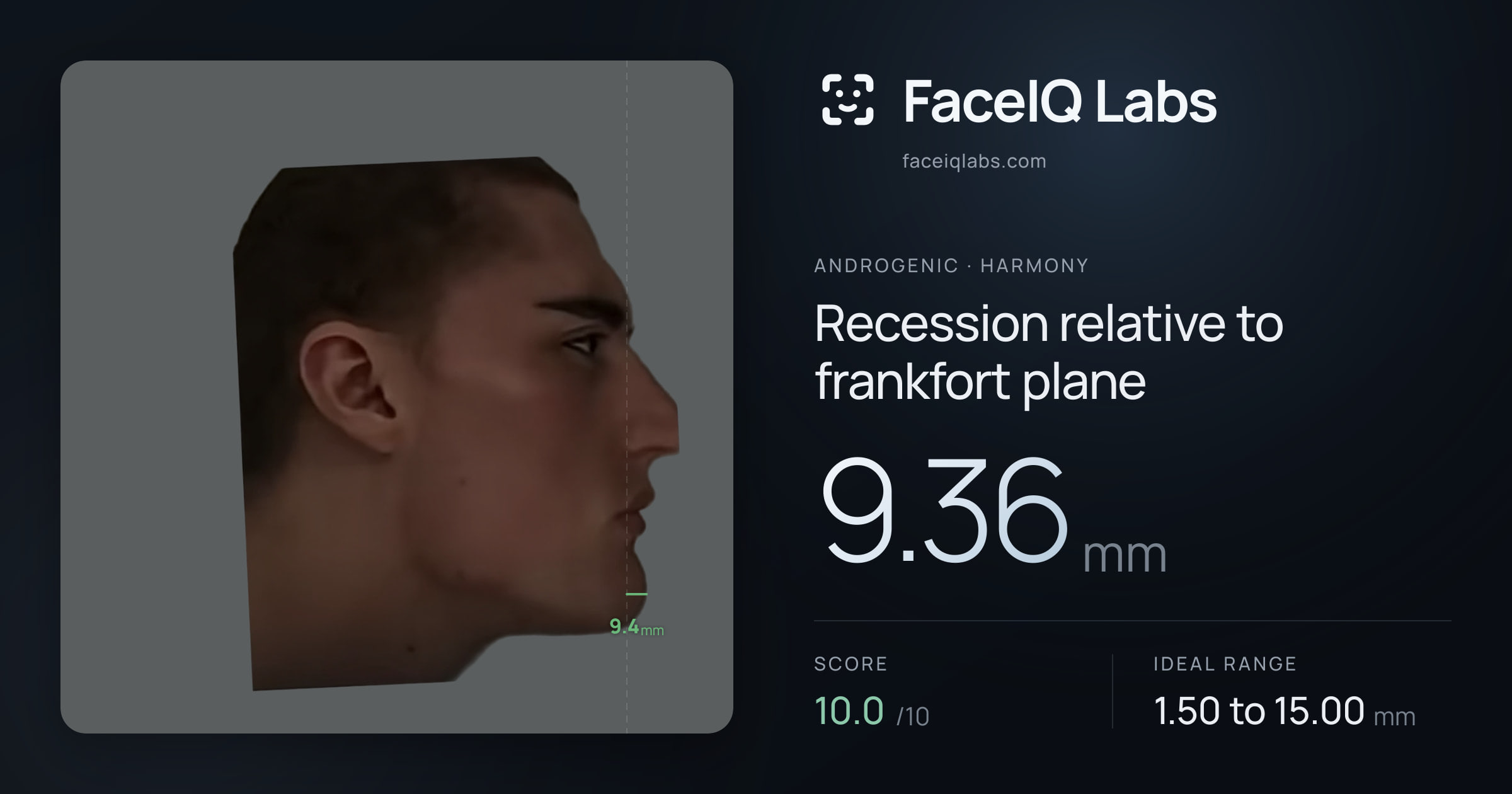 Androgenic Recession relative to frankfort plane: 9.36mm, drawn on the photo