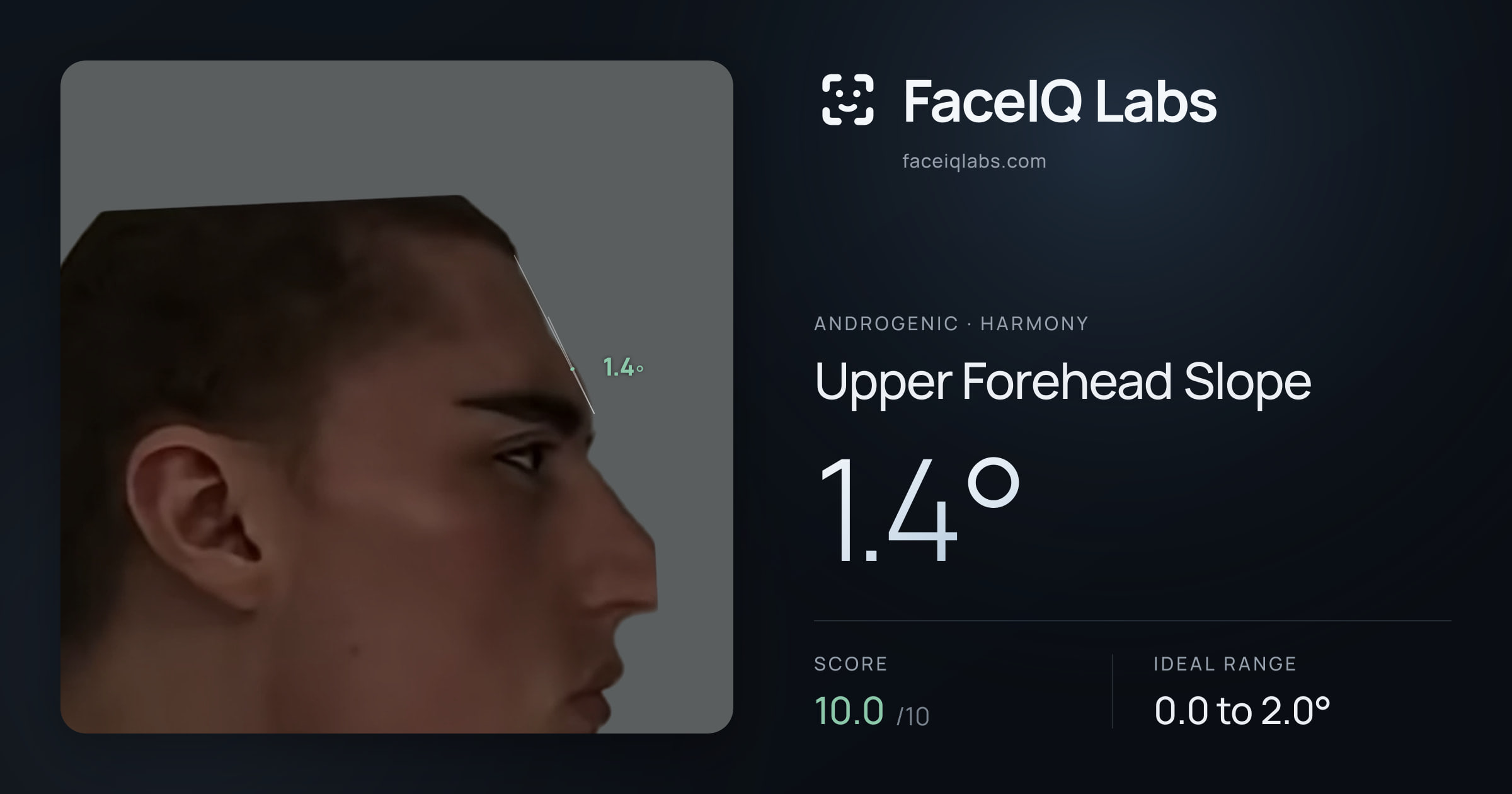 Androgenic Upper Forehead Slope: 1.3°, drawn on the photo