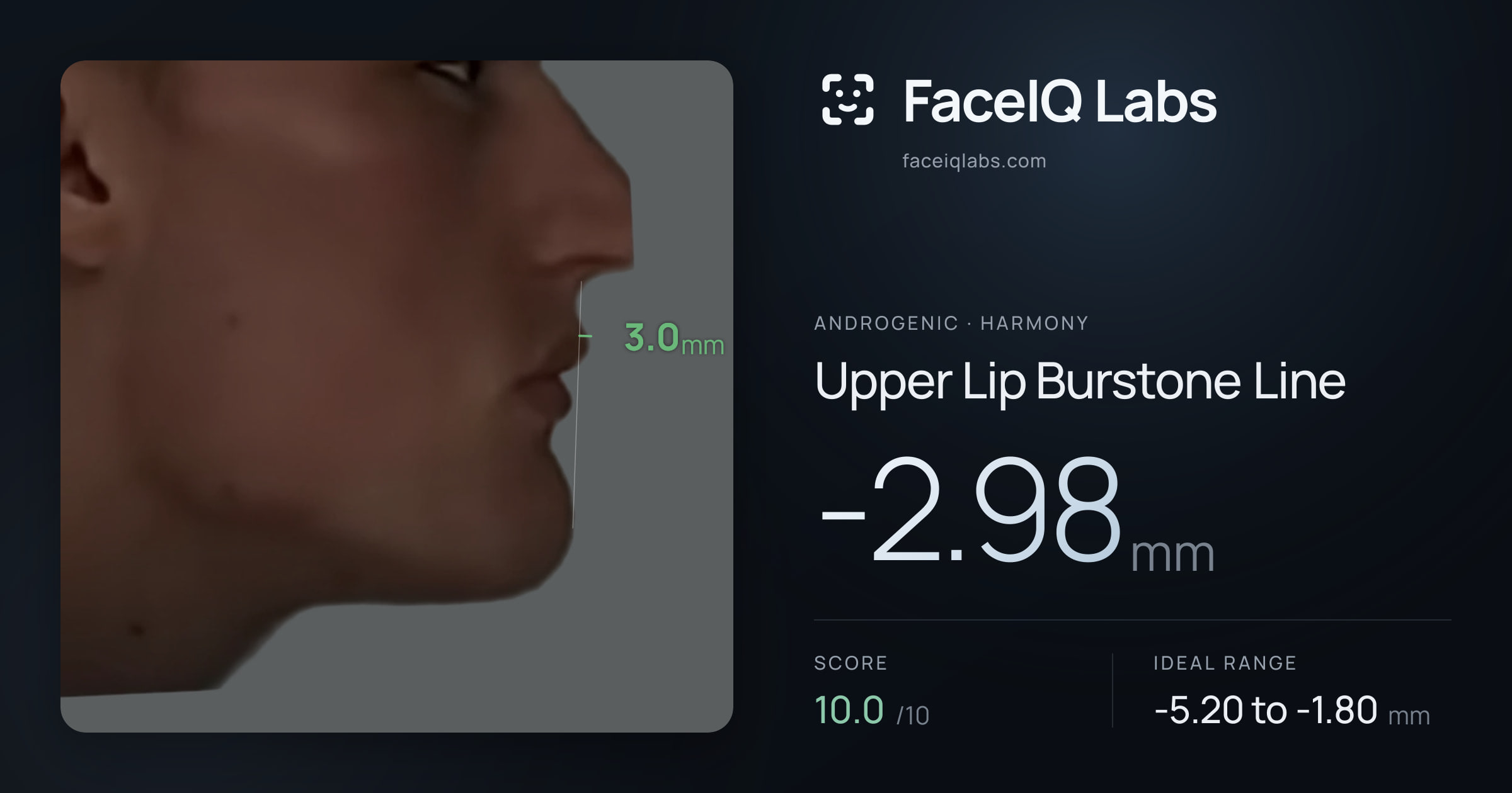 Androgenic Upper Lip Burstone Line: -2.98mm, drawn on the photo