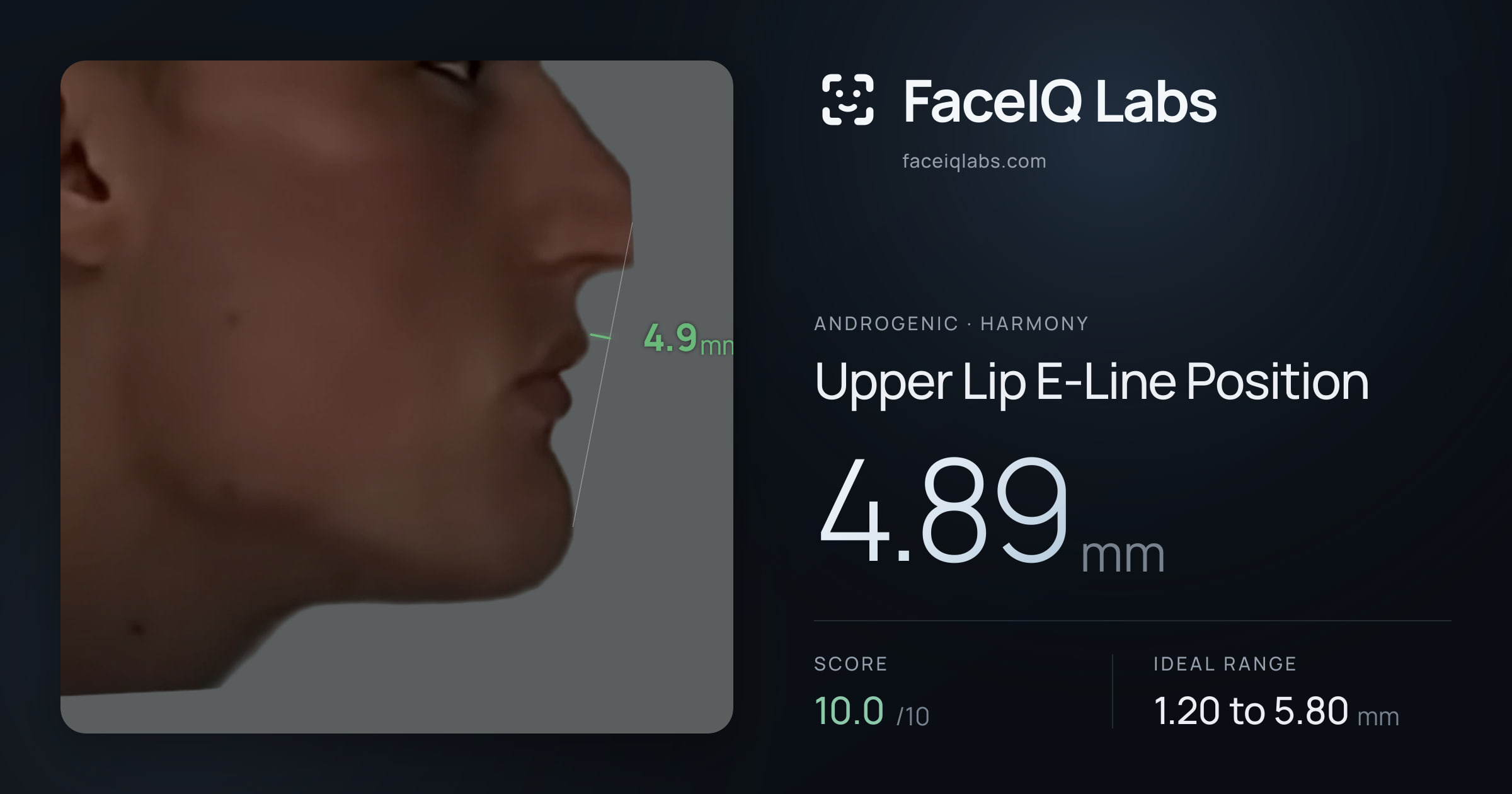 Androgenic Upper Lip E-Line Position: 4.89mm, drawn on the photo
