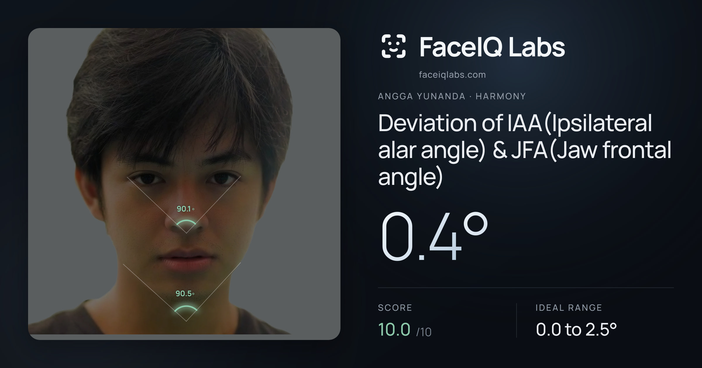 Angga Yunanda Deviation of IAA(Ipsilateral alar angle) & JFA(Jaw frontal angle): 0.4°, drawn on the photo