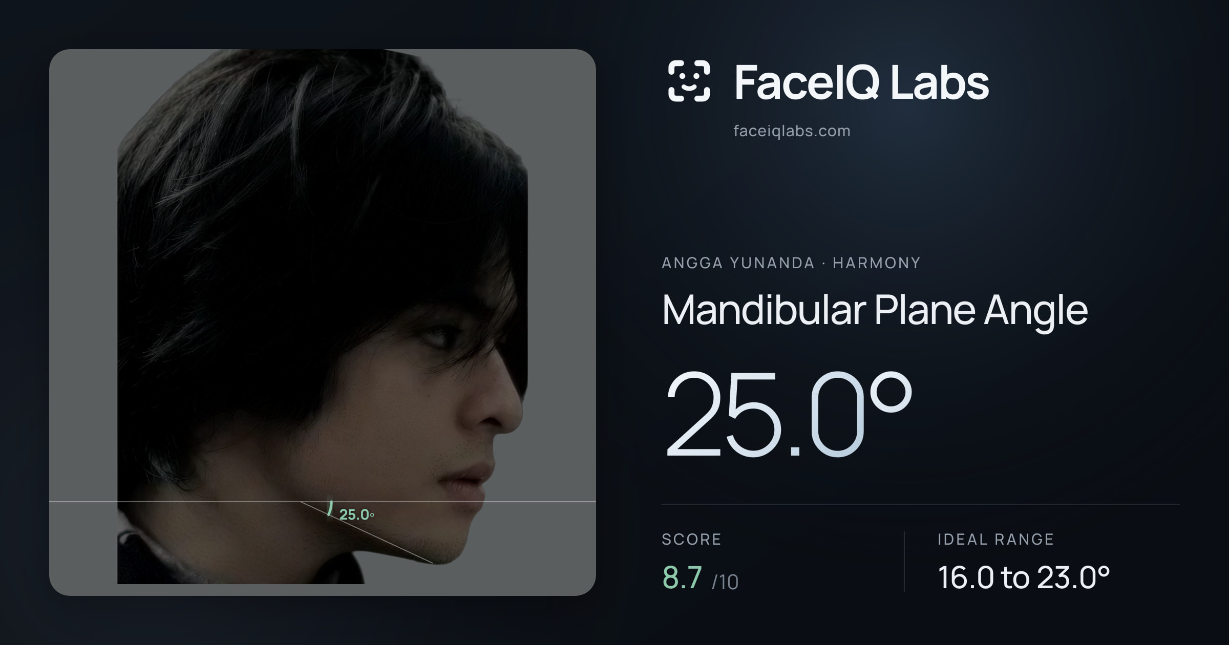 Angga Yunanda Mandibular Plane Angle: 25.0°, drawn on the photo