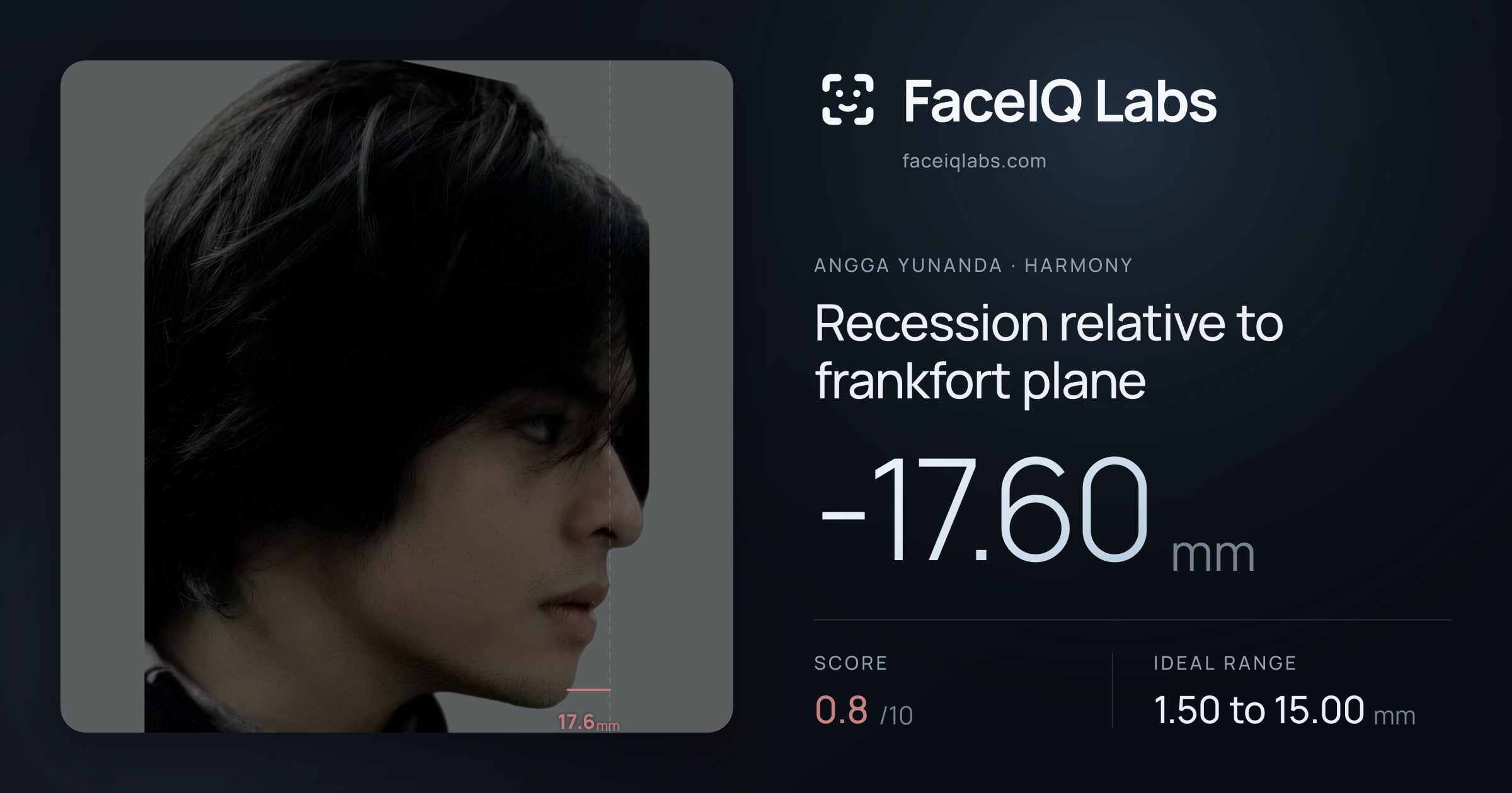Angga Yunanda Recession relative to frankfort plane: -17.60mm, drawn on the photo