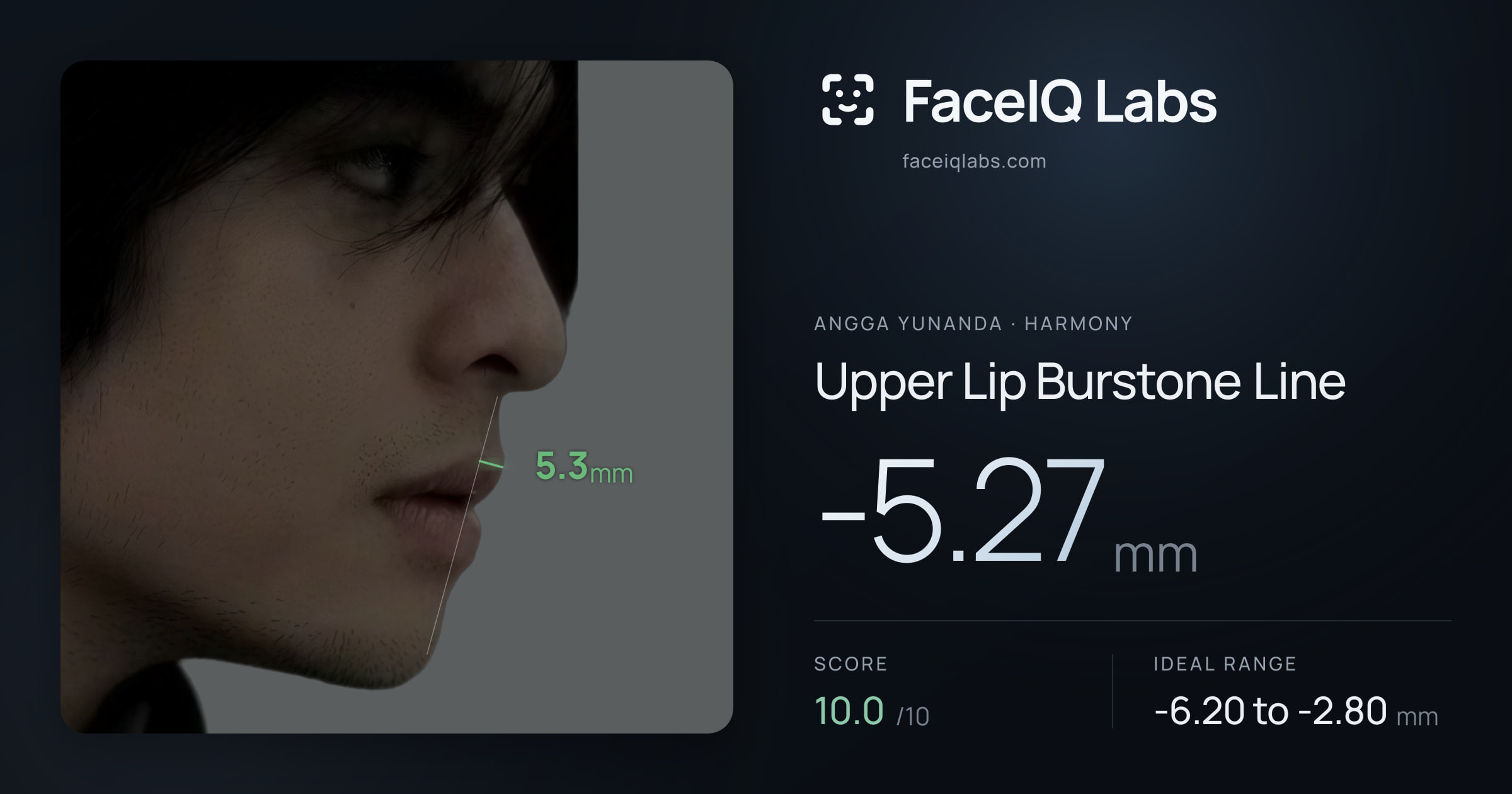 Angga Yunanda Upper Lip Burstone Line: -5.27mm, drawn on the photo