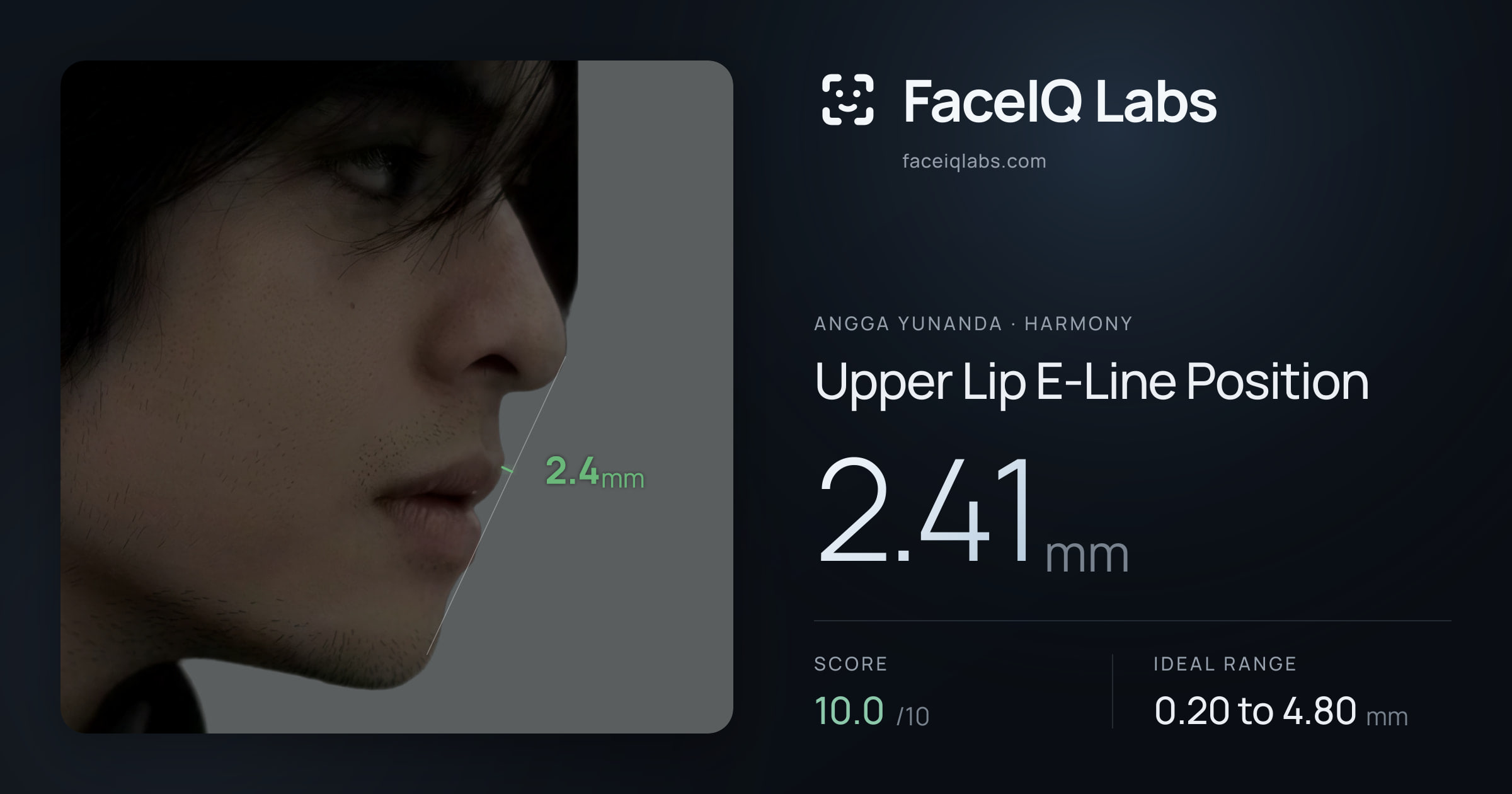 Angga Yunanda Upper Lip E-Line Position: 2.41mm, drawn on the photo