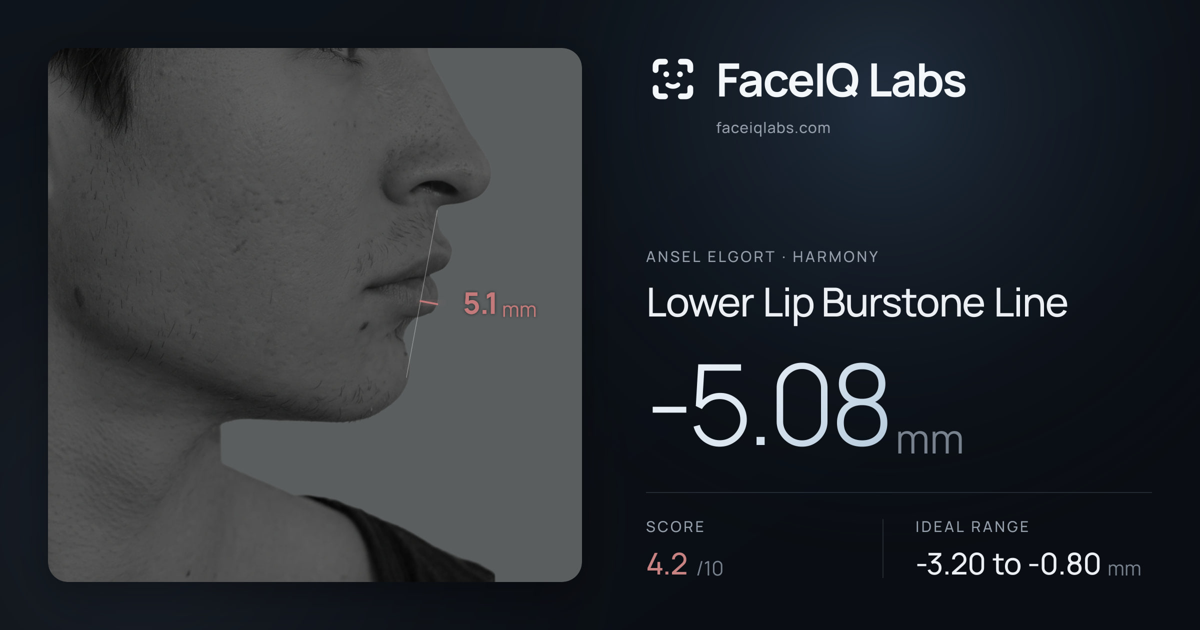 Ansel Elgort Lower Lip Burstone Line: -5.08mm, drawn on the photo