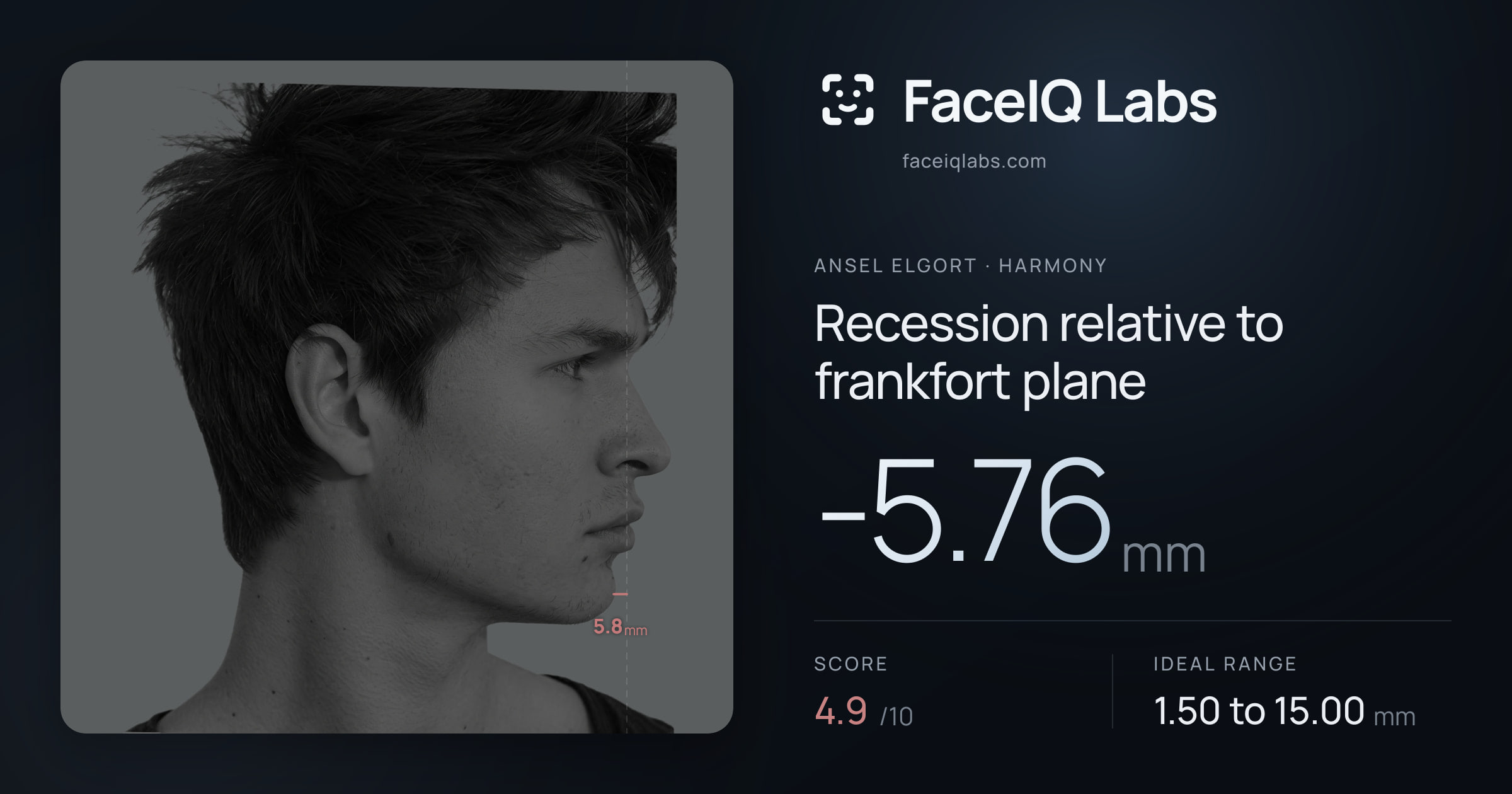 Ansel Elgort Recession relative to frankfort plane: -5.76mm, drawn on the photo