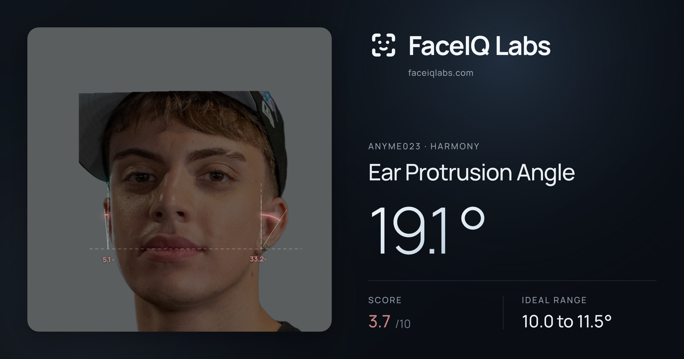 Anyme023 Ear Protrusion Angle: 19.1°, drawn on the photo