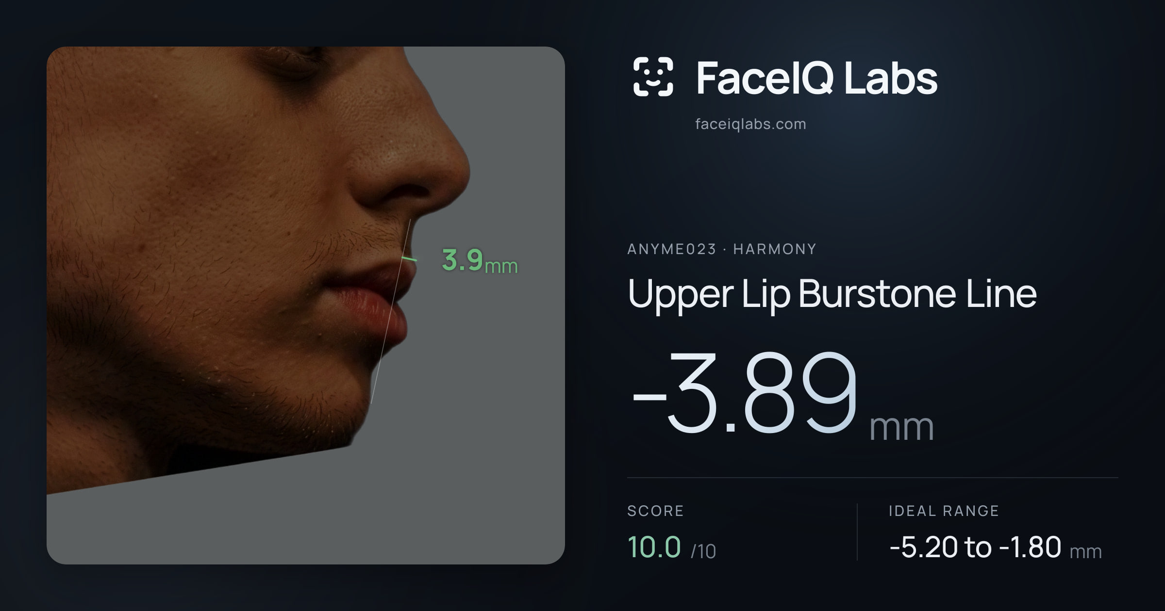 Anyme023 Upper Lip Burstone Line: -3.89mm, drawn on the photo