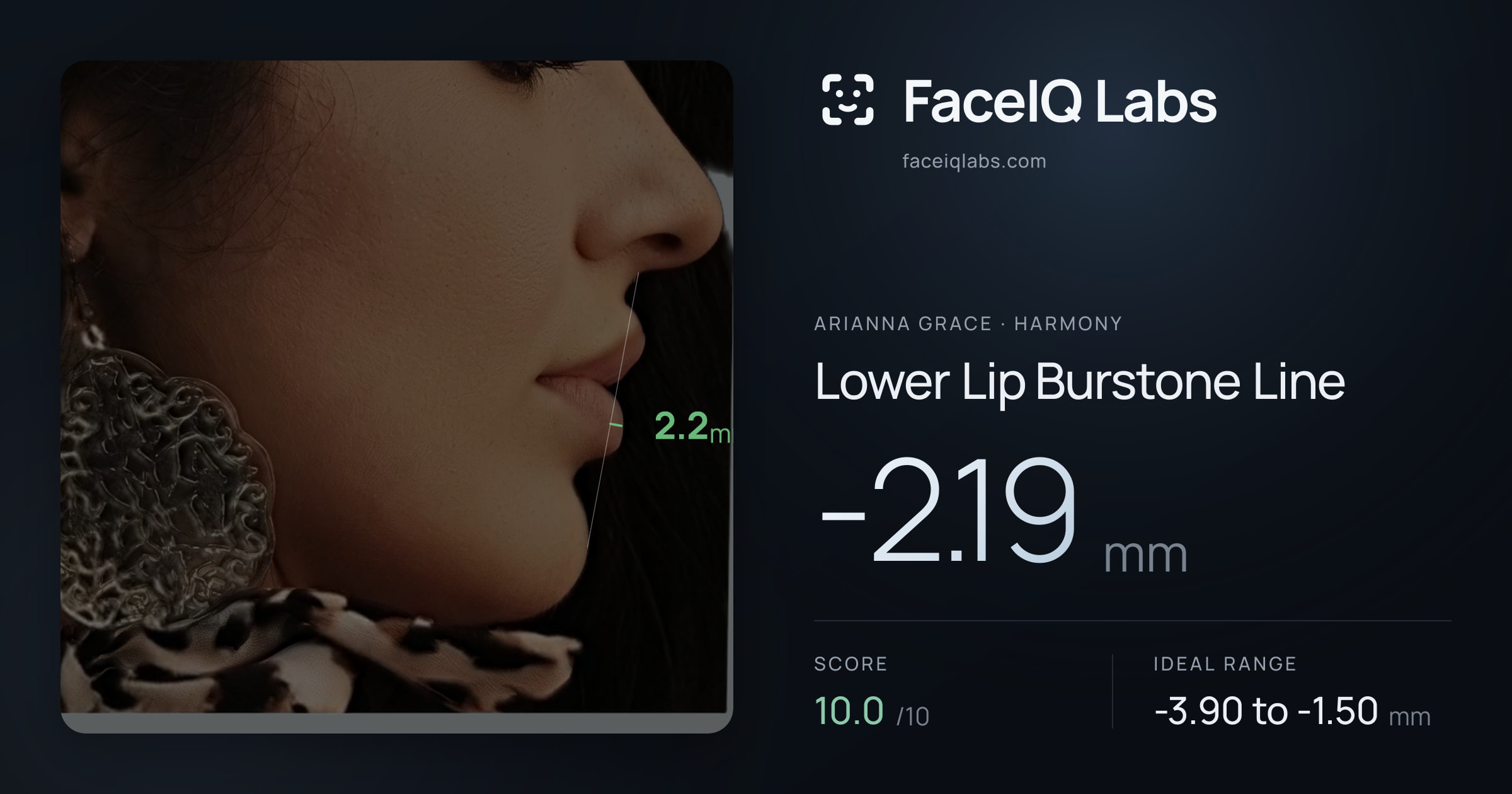 Arianna Grace Lower Lip Burstone Line: -2.19mm, drawn on the photo