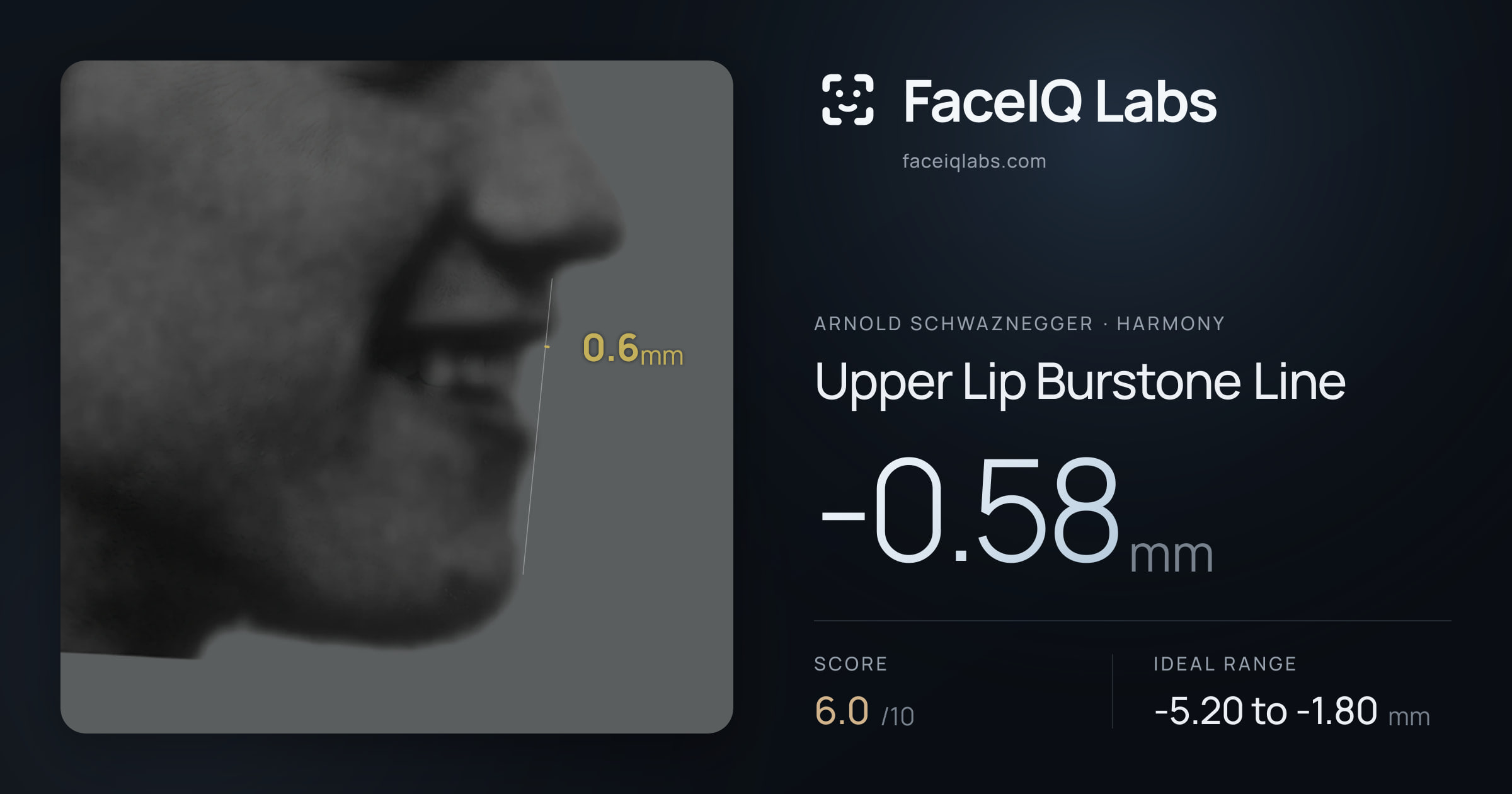 Arnold Schwaznegger Upper Lip Burstone Line: -0.58mm, drawn on the photo