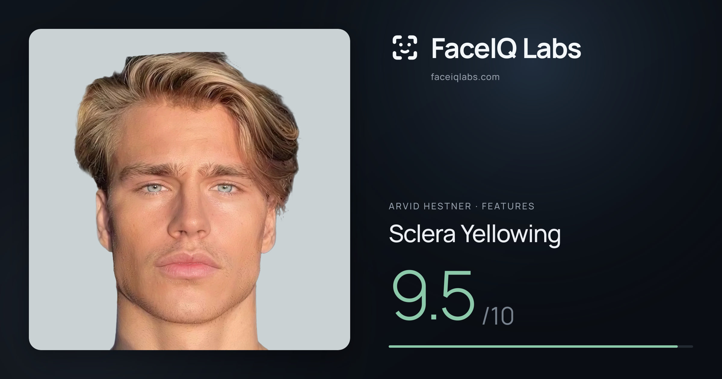 Arvid Hestner Sclera Yellowing: 9.5/10, drawn on the photo