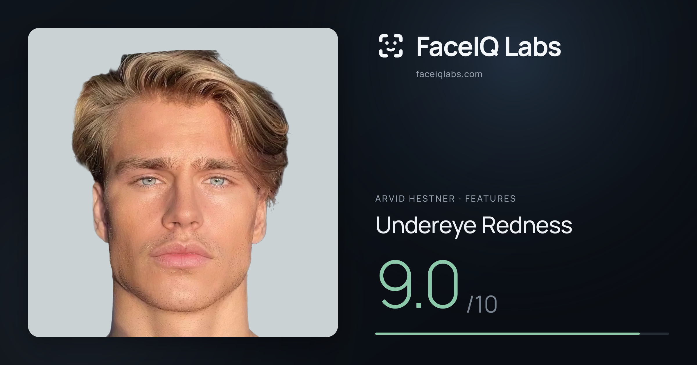 Arvid Hestner Undereye Redness: 9.0/10, drawn on the photo