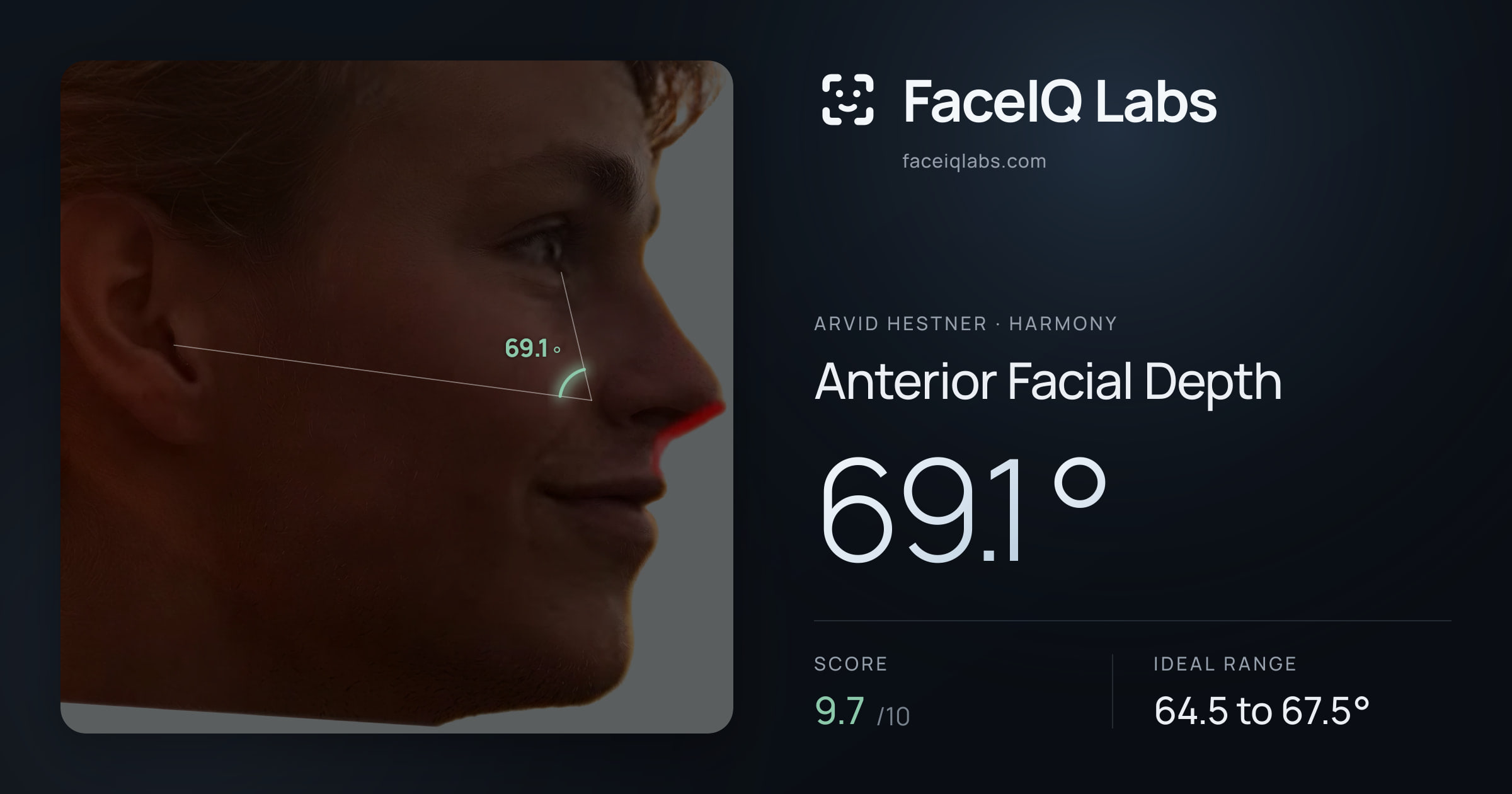 Arvid Hestner Anterior Facial Depth: 69.1°, drawn on the photo