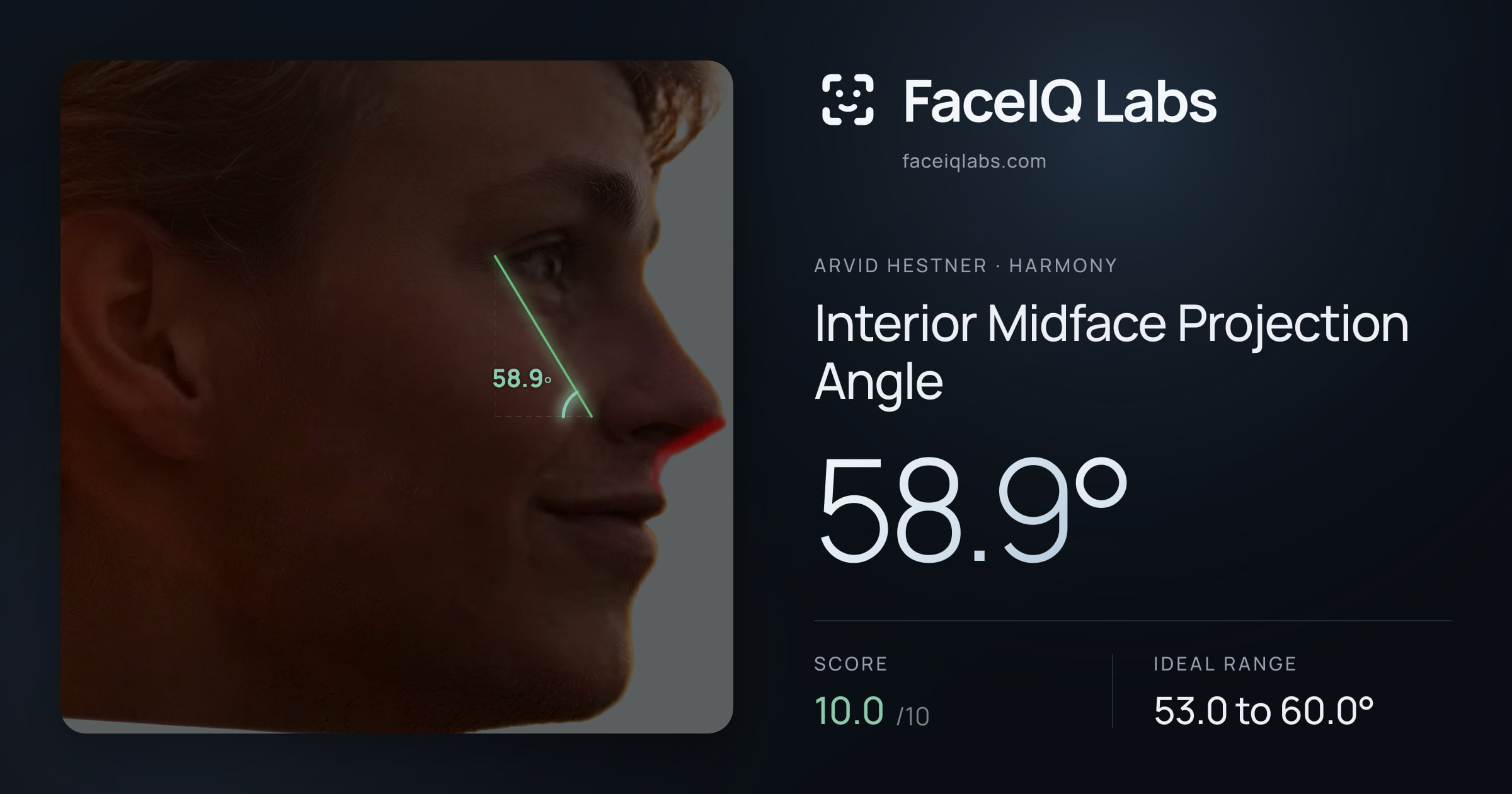 Arvid Hestner Interior Midface Projection Angle: 58.9°, drawn on the photo