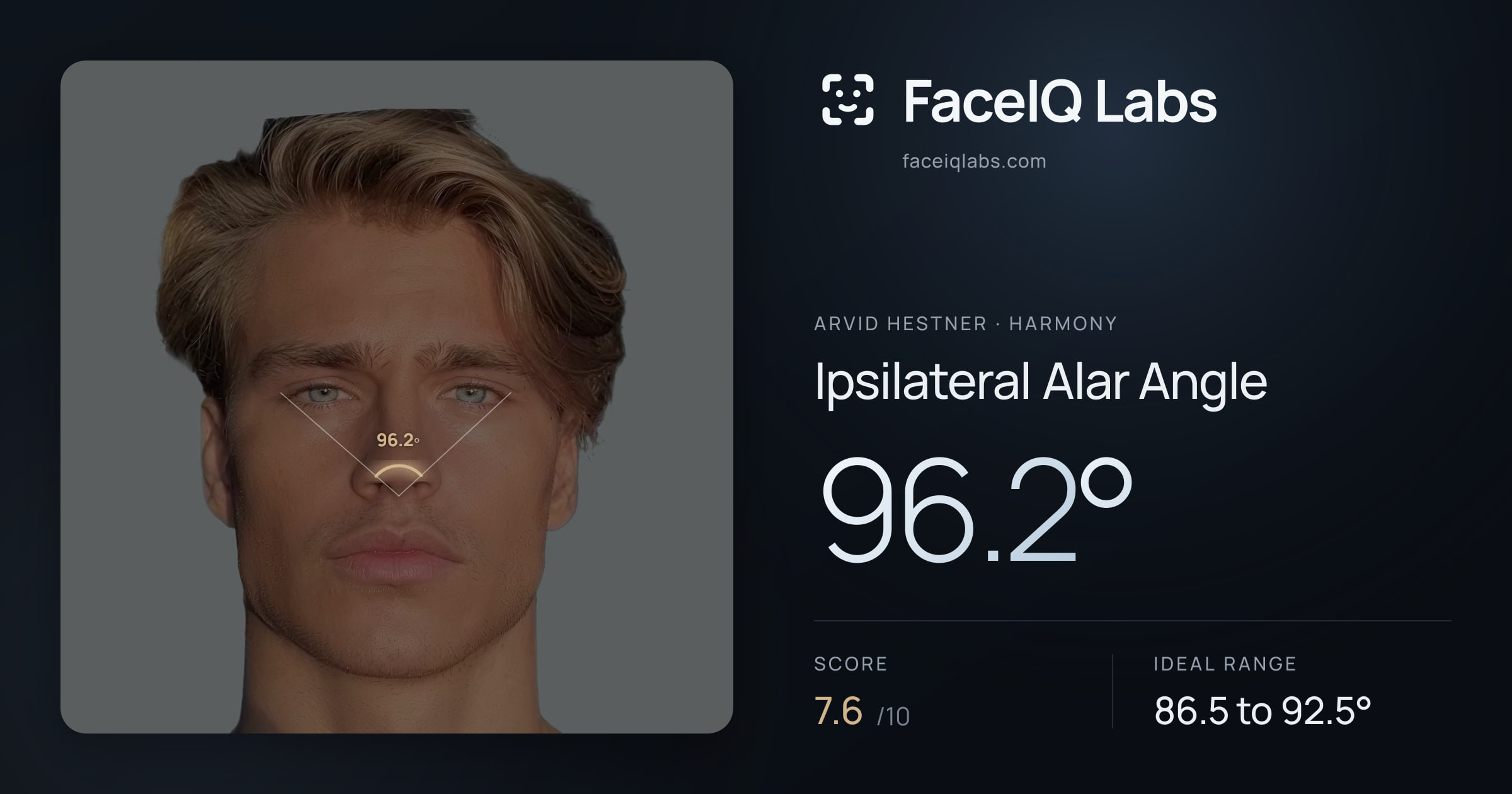 Arvid Hestner Ipsilateral Alar Angle: 96.2°, drawn on the photo