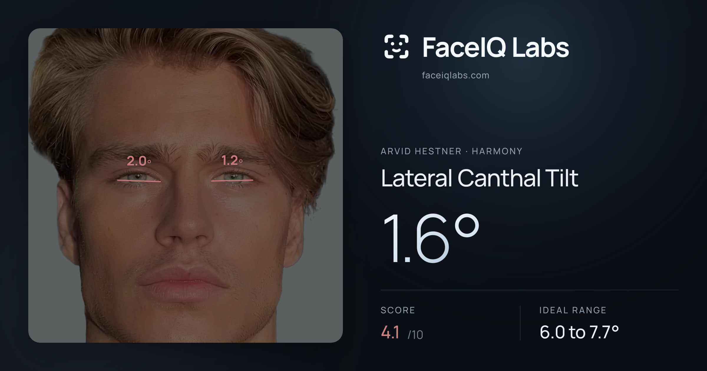 Arvid Hestner Lateral Canthal Tilt: 1.6°, drawn on the photo