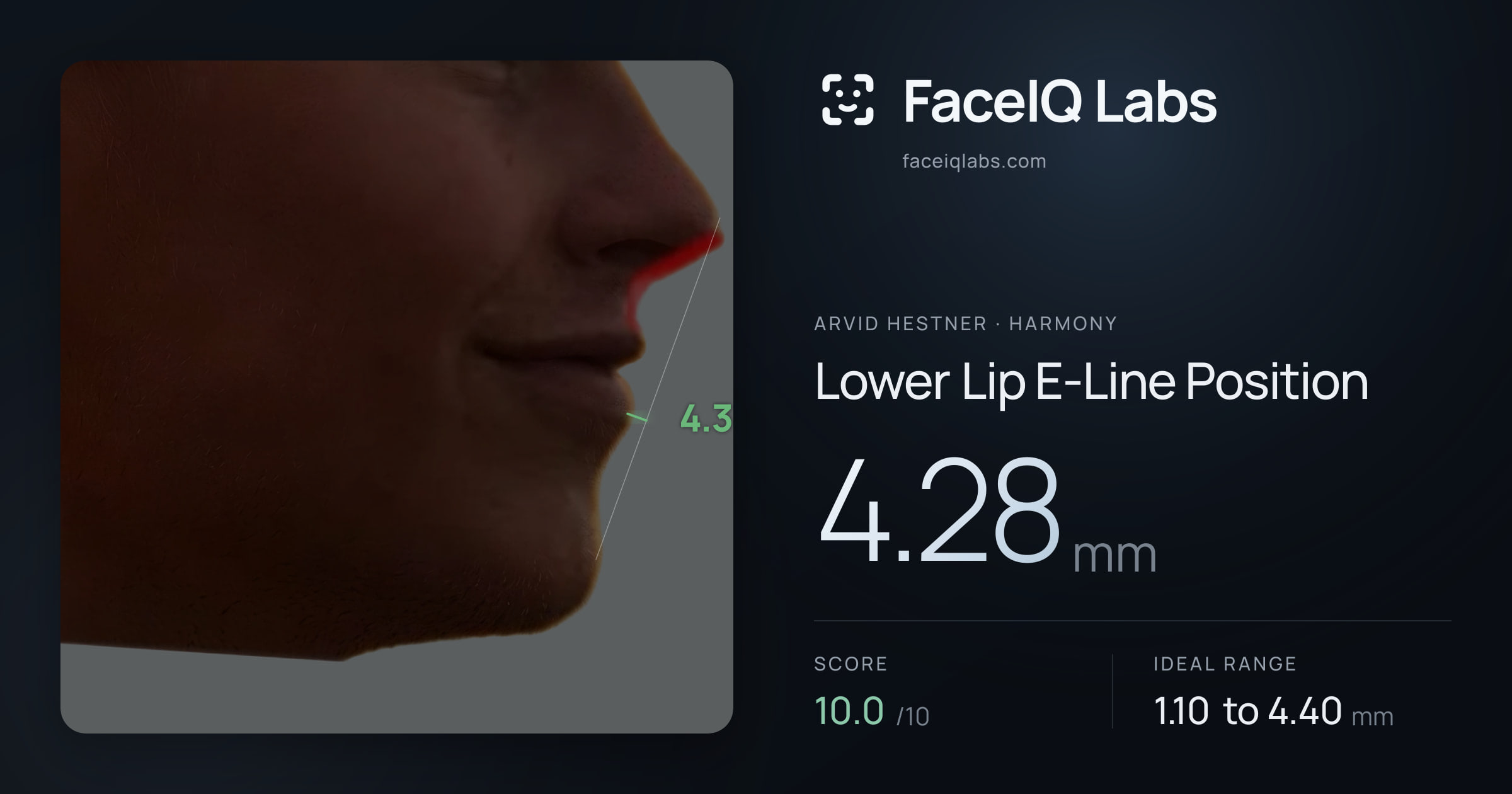 Arvid Hestner Lower Lip E-Line Position: 4.28mm, drawn on the photo