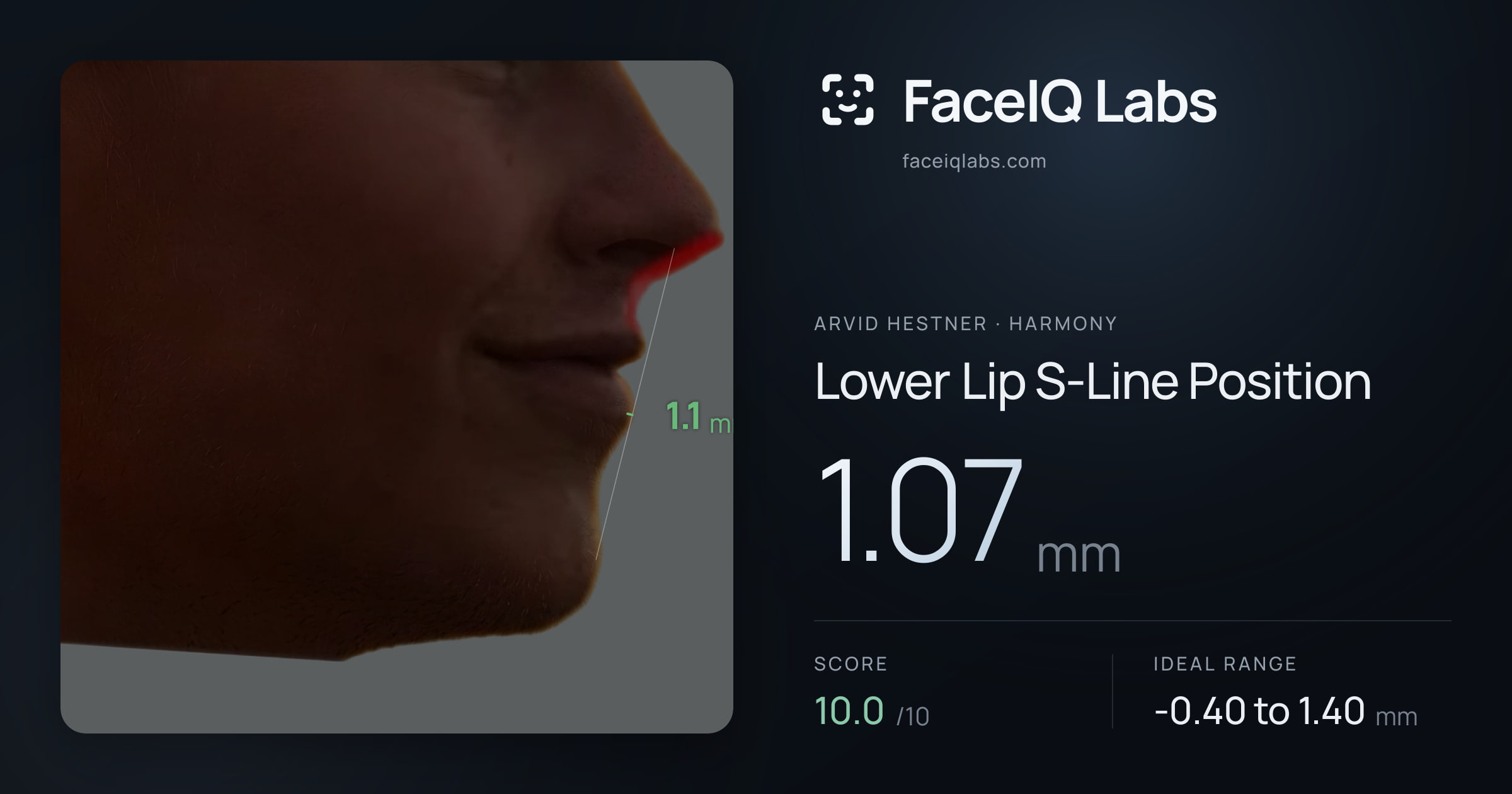 Arvid Hestner Lower Lip S-Line Position: 1.07mm, drawn on the photo