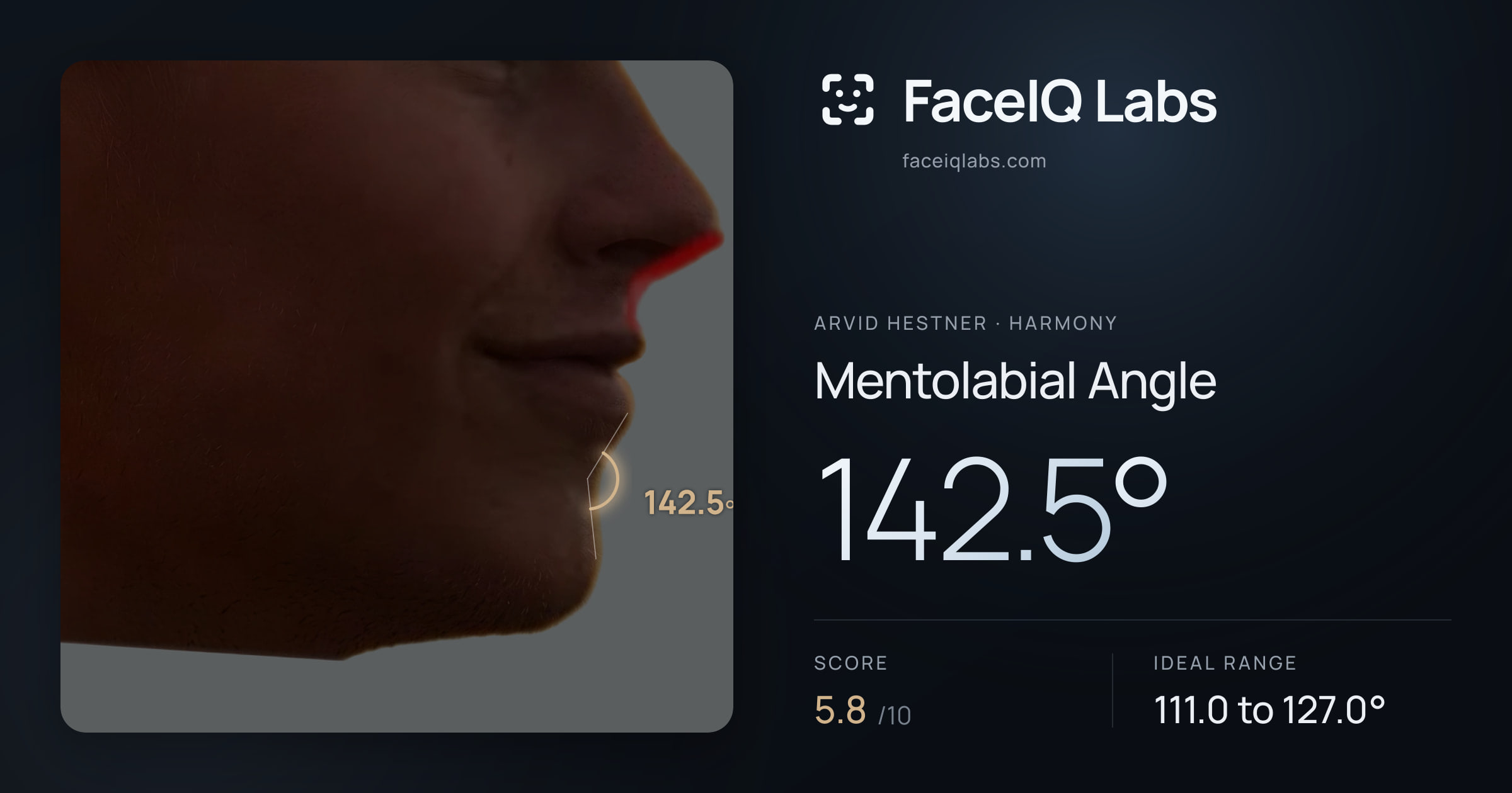 Arvid Hestner Mentolabial Angle: 142.5°, drawn on the photo