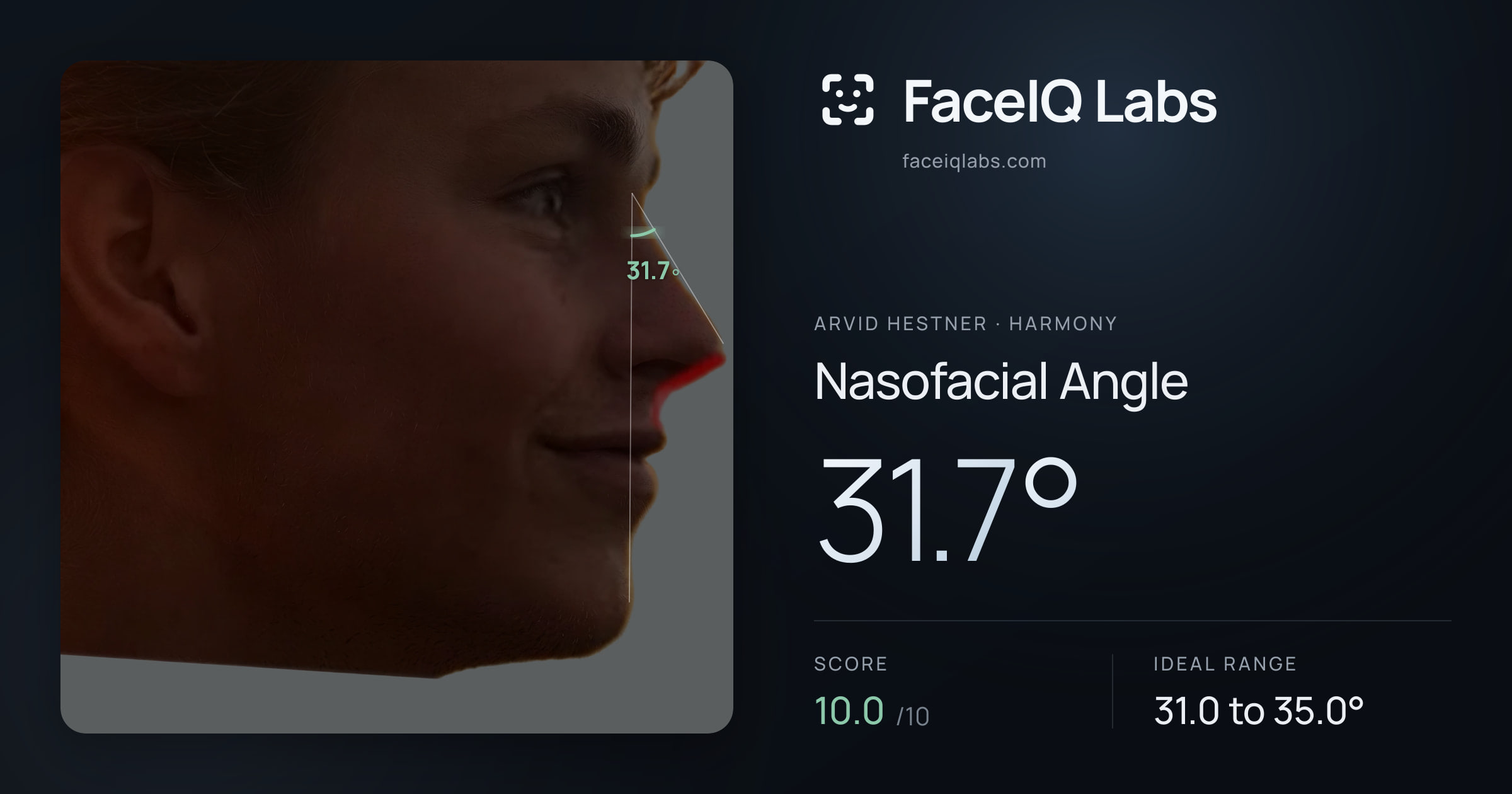 Arvid Hestner Nasofacial Angle: 31.7°, drawn on the photo
