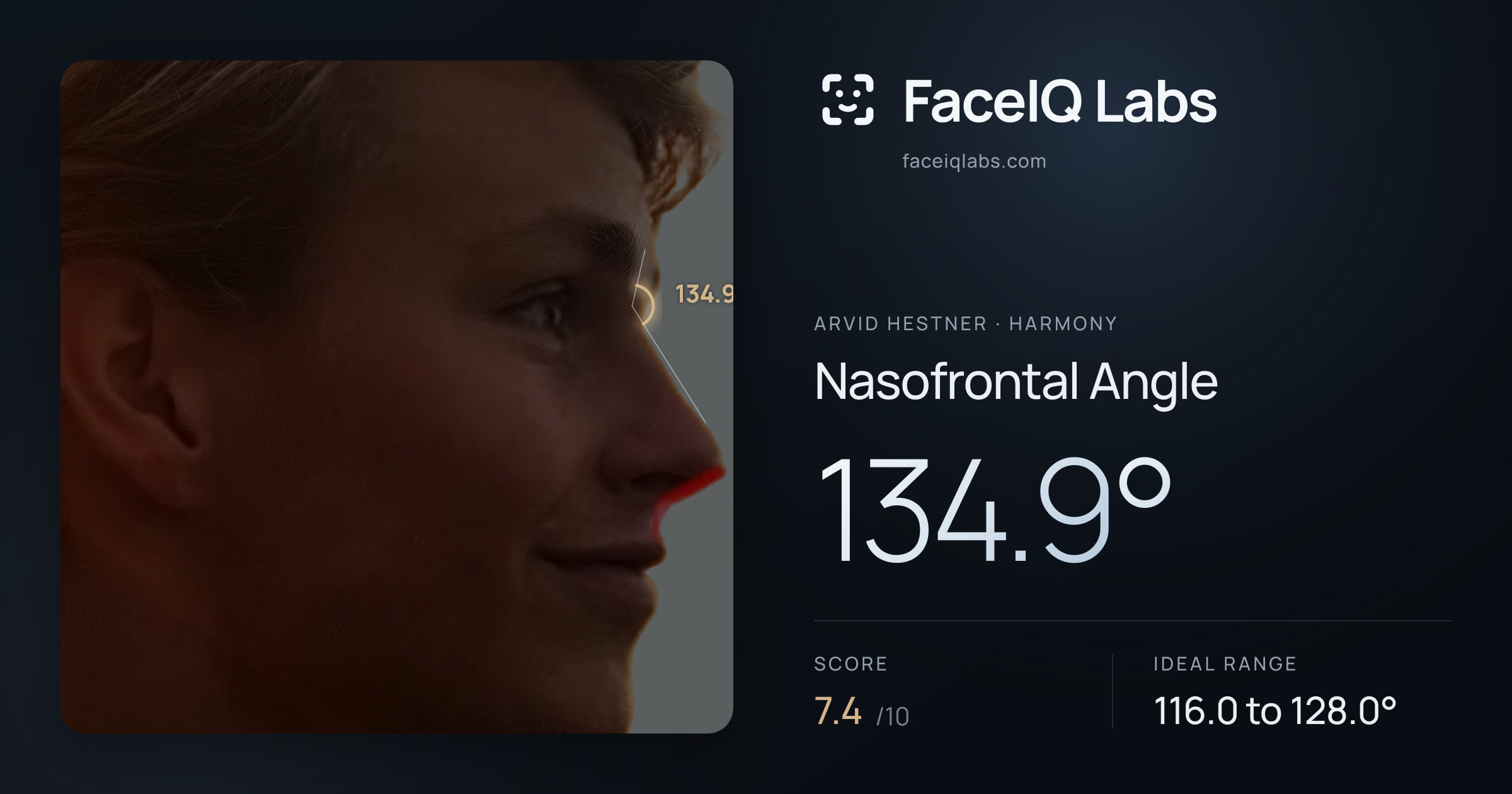 Arvid Hestner Nasofrontal Angle: 134.9°, drawn on the photo