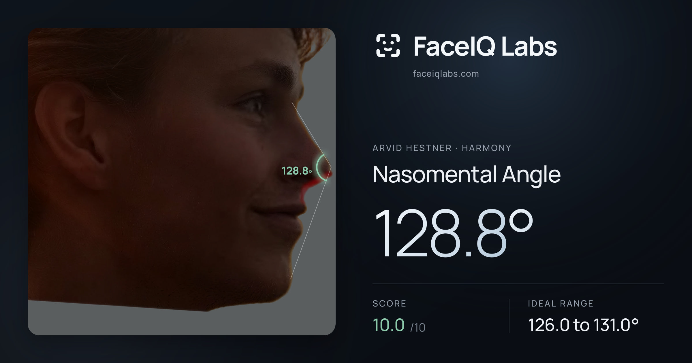 Arvid Hestner Nasomental Angle: 128.8°, drawn on the photo