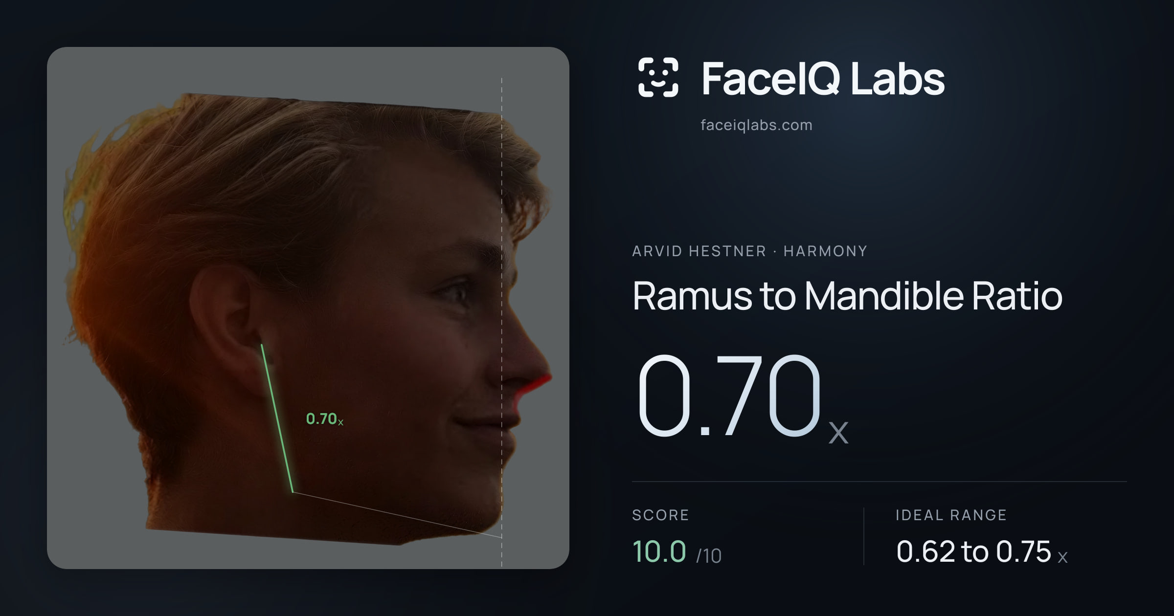 Arvid Hestner Ramus to Mandible Ratio: 0.70x, drawn on the photo