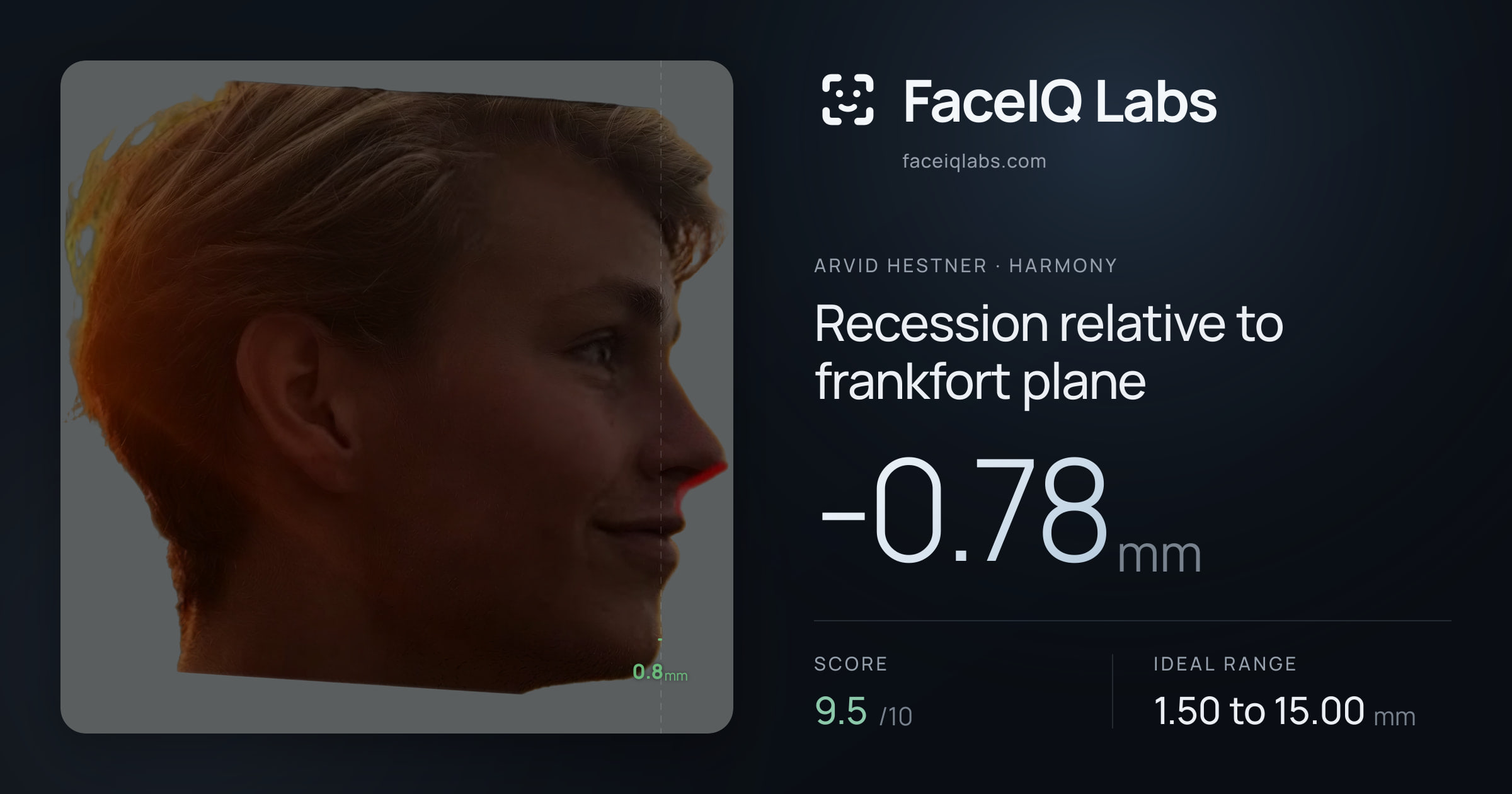 Arvid Hestner Recession relative to frankfort plane: -0.78mm, drawn on the photo