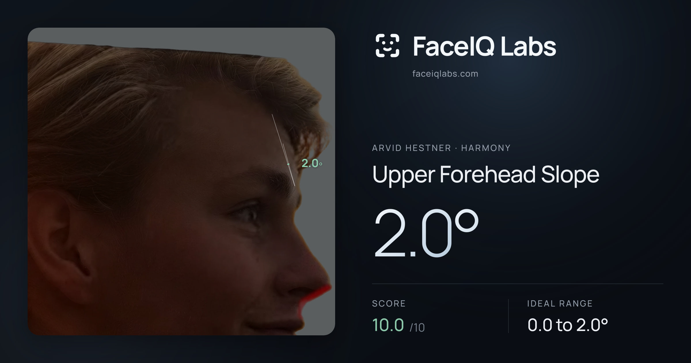 Arvid Hestner Upper Forehead Slope: 2.0°, drawn on the photo