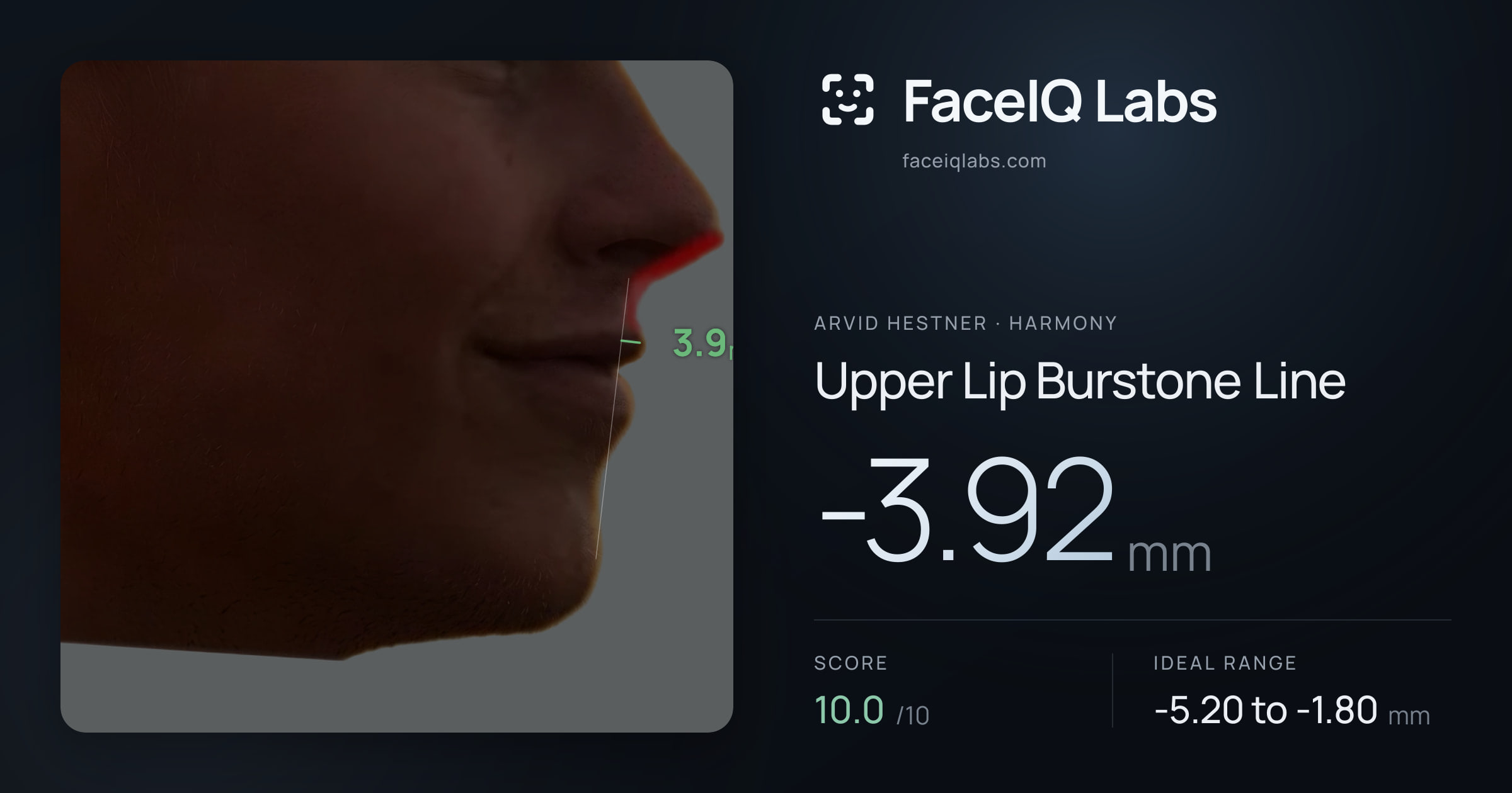 Arvid Hestner Upper Lip Burstone Line: -3.92mm, drawn on the photo