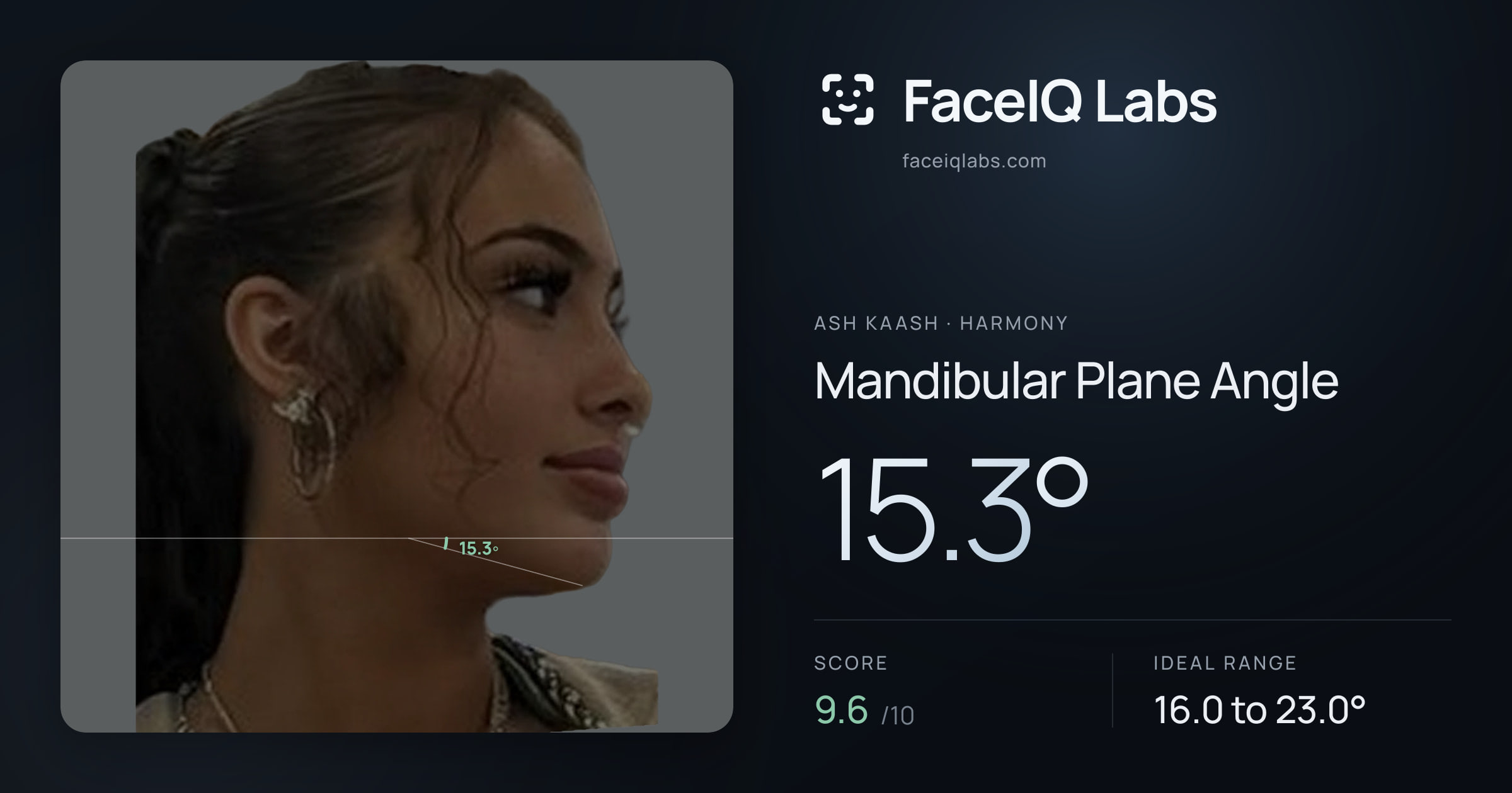 Ash Kaash Mandibular Plane Angle: 15.3°, drawn on the photo