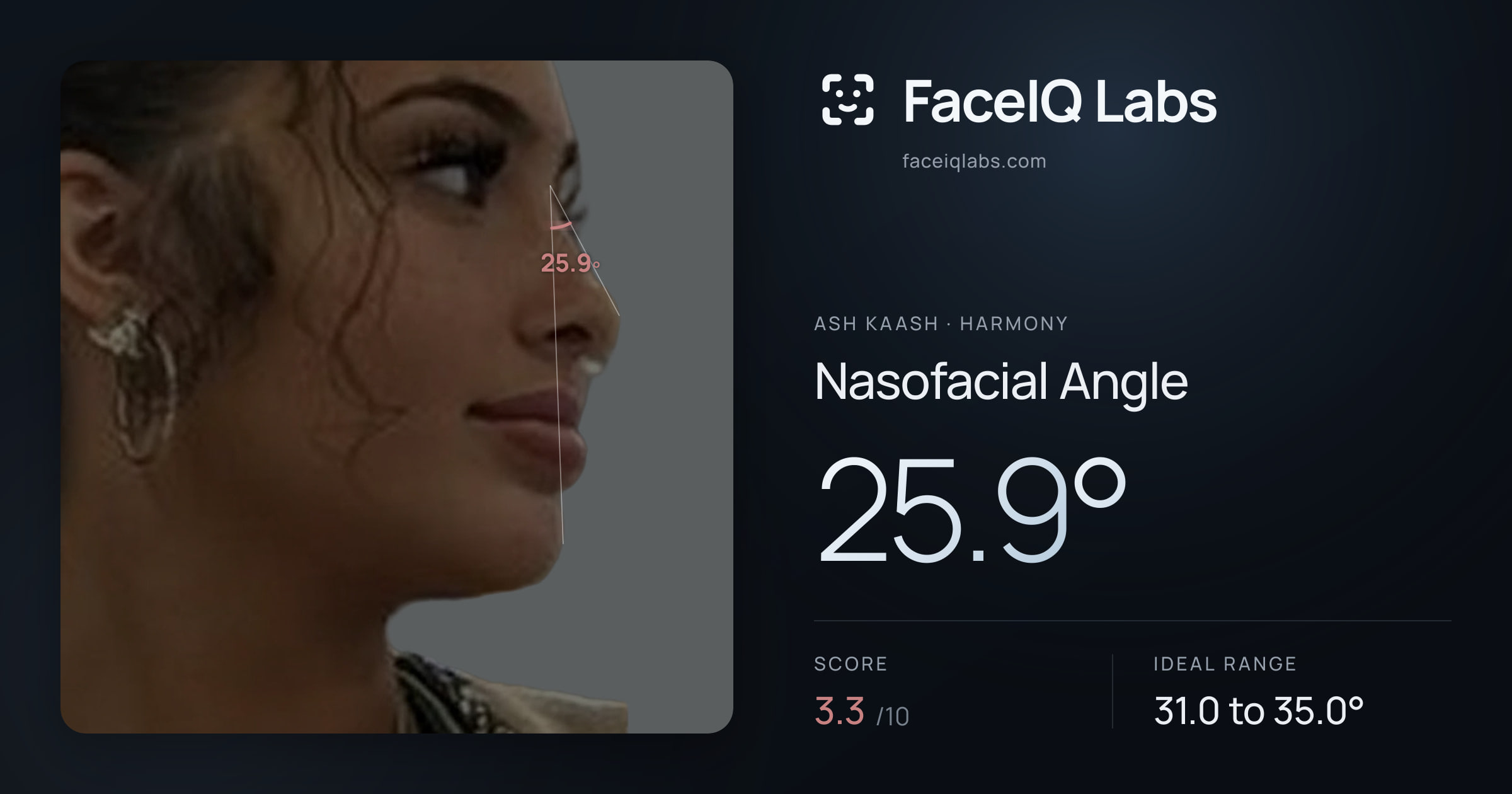 Ash Kaash Nasofacial Angle: 25.9°, drawn on the photo