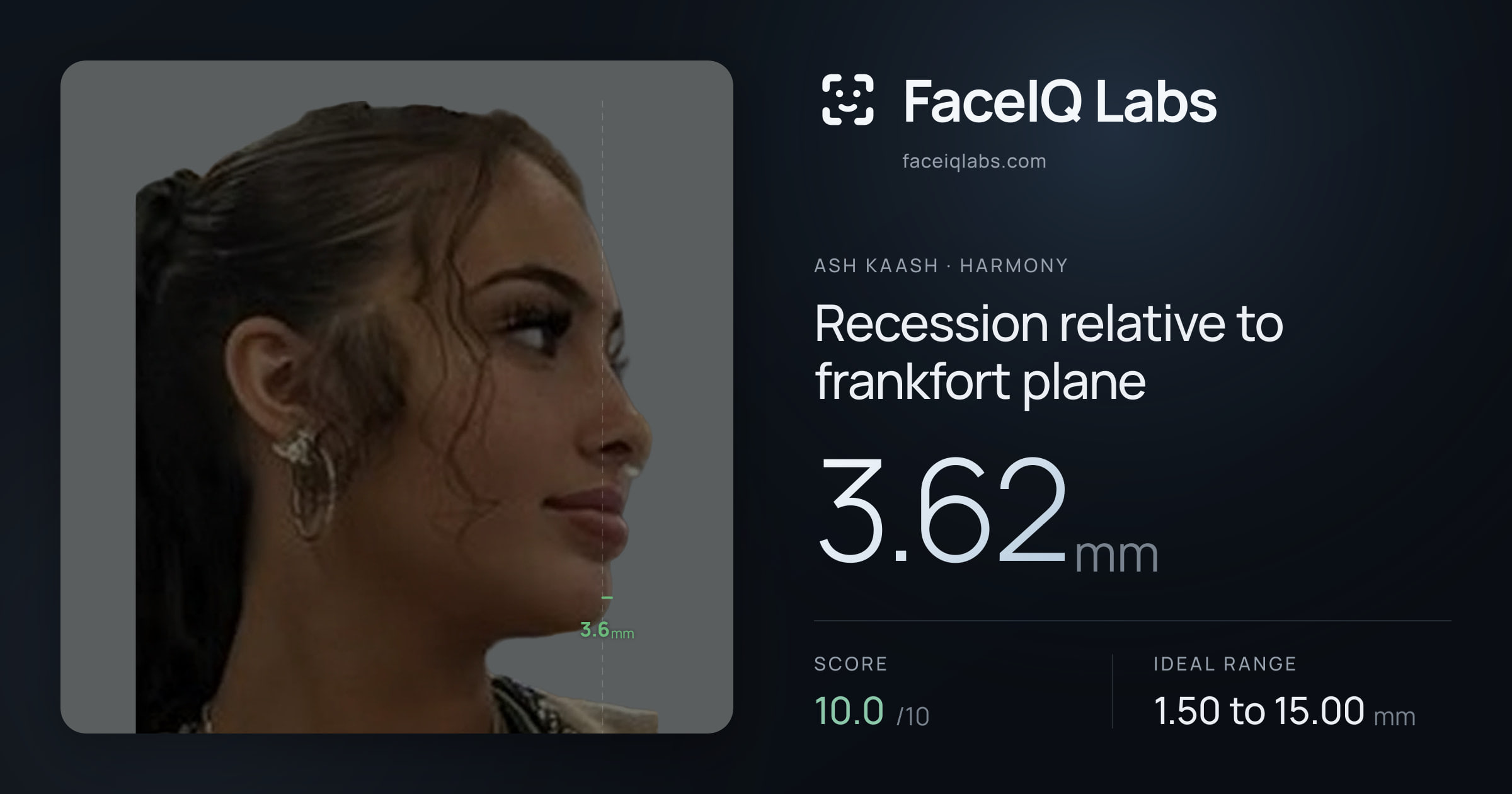 Ash Kaash Recession relative to frankfort plane: 3.62mm, drawn on the photo