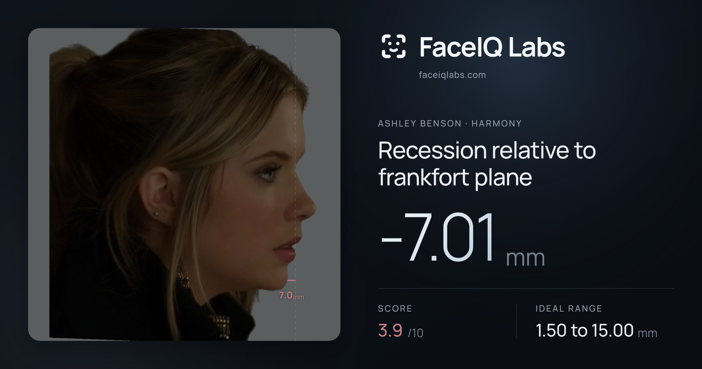 Ashley Benson Recession relative to frankfort plane: -7.01mm, drawn on the photo