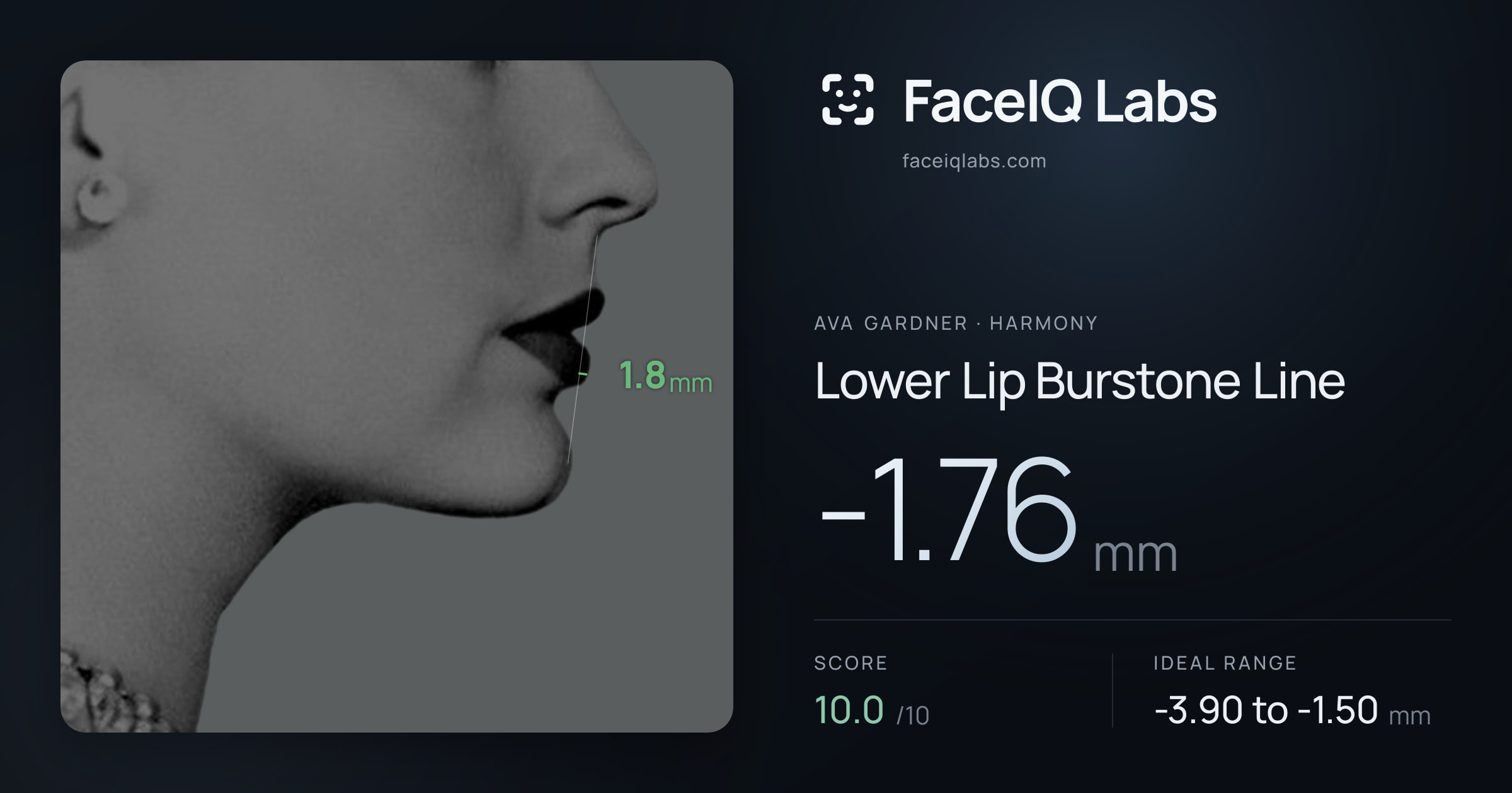 Ava Gardner Lower Lip Burstone Line: -1.76mm, drawn on the photo