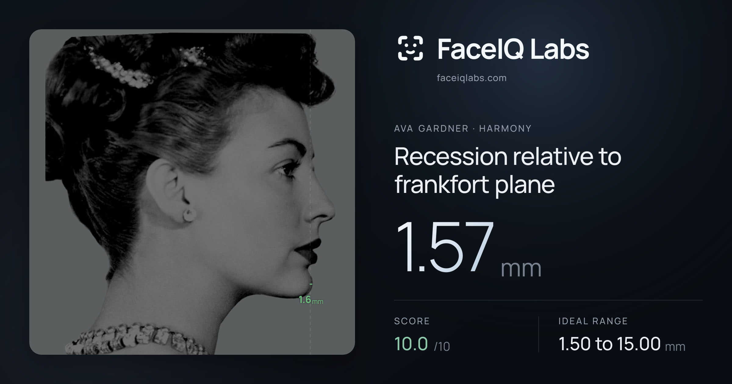Ava Gardner Recession relative to frankfort plane: 1.57mm, drawn on the photo