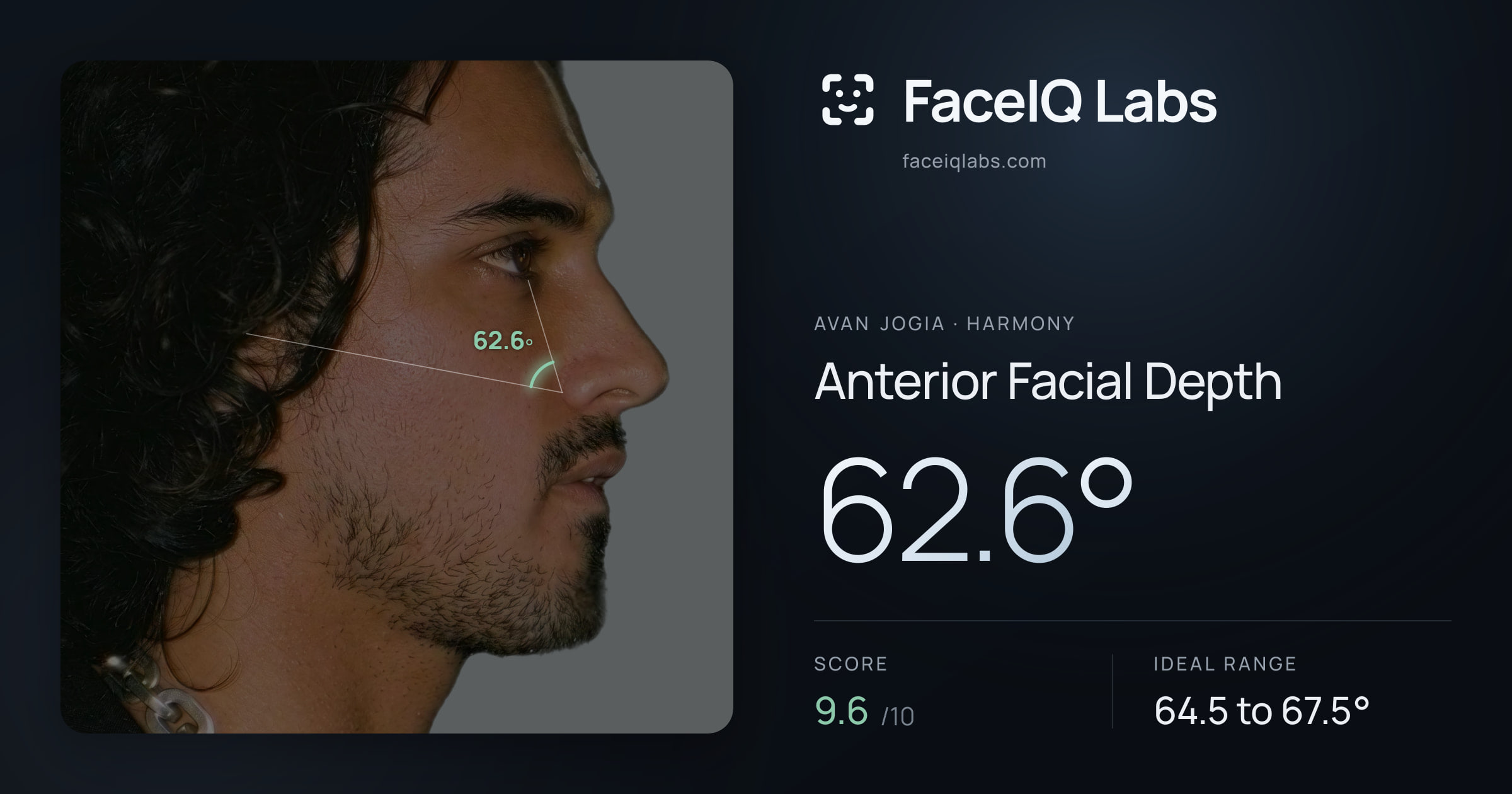 Avan Jogia Anterior Facial Depth: 62.6°, drawn on the photo