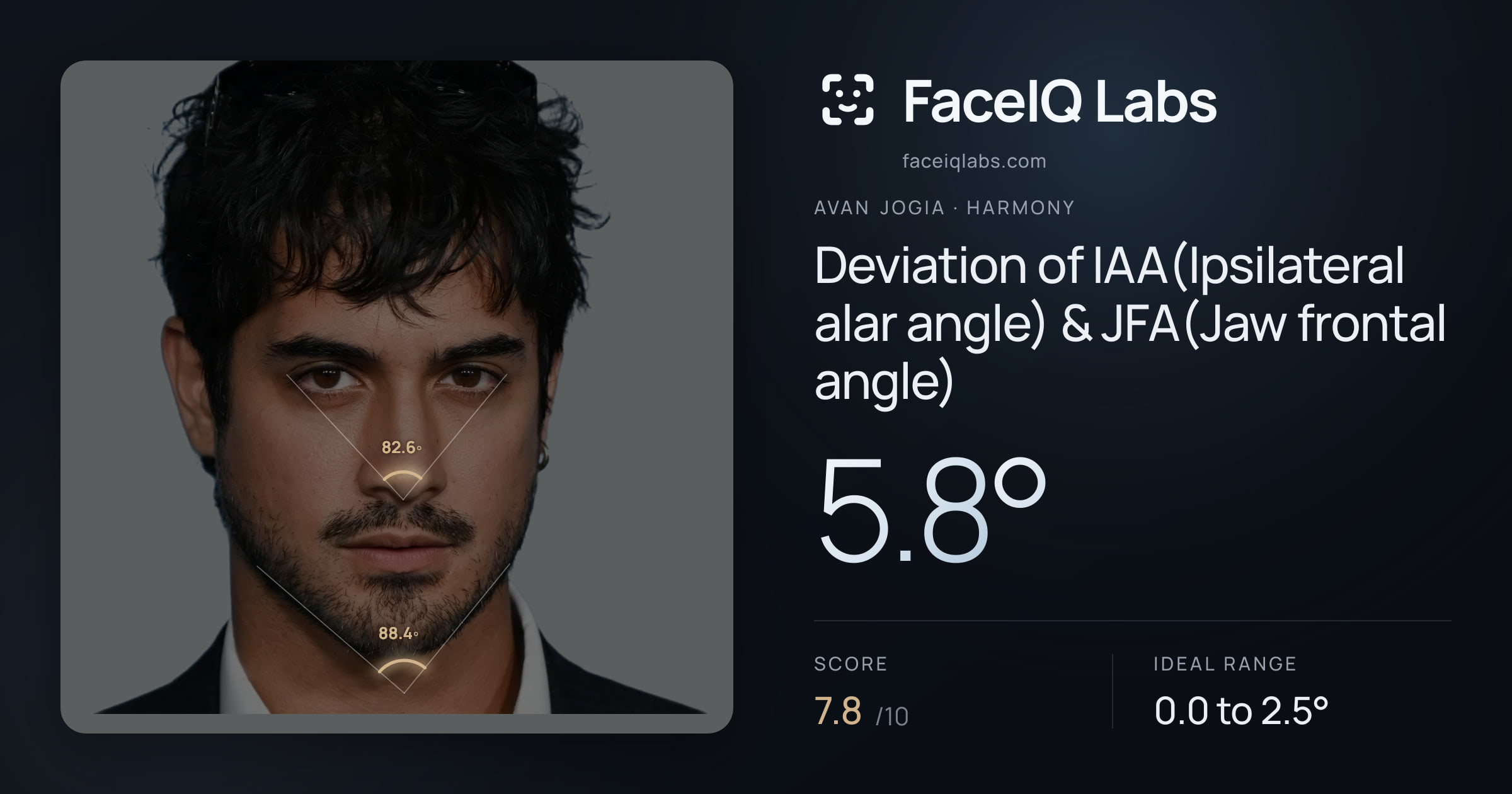 Avan Jogia Deviation of IAA(Ipsilateral alar angle) & JFA(Jaw frontal angle): 5.8°, drawn on the photo