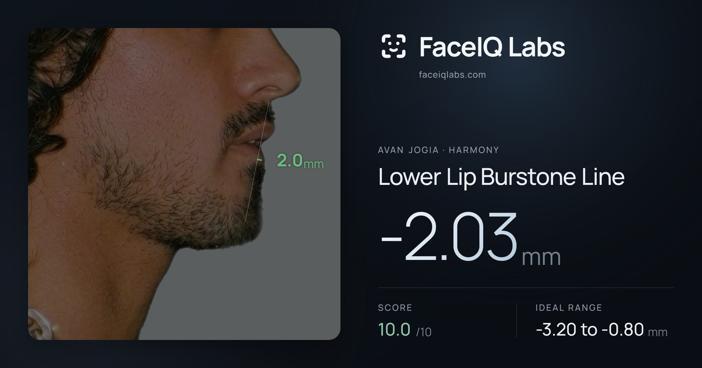 Avan Jogia Lower Lip Burstone Line: -2.03mm, drawn on the photo