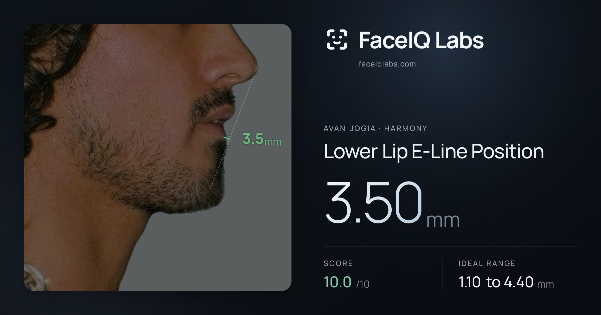 Avan Jogia Lower Lip E-Line Position: 3.50mm, drawn on the photo