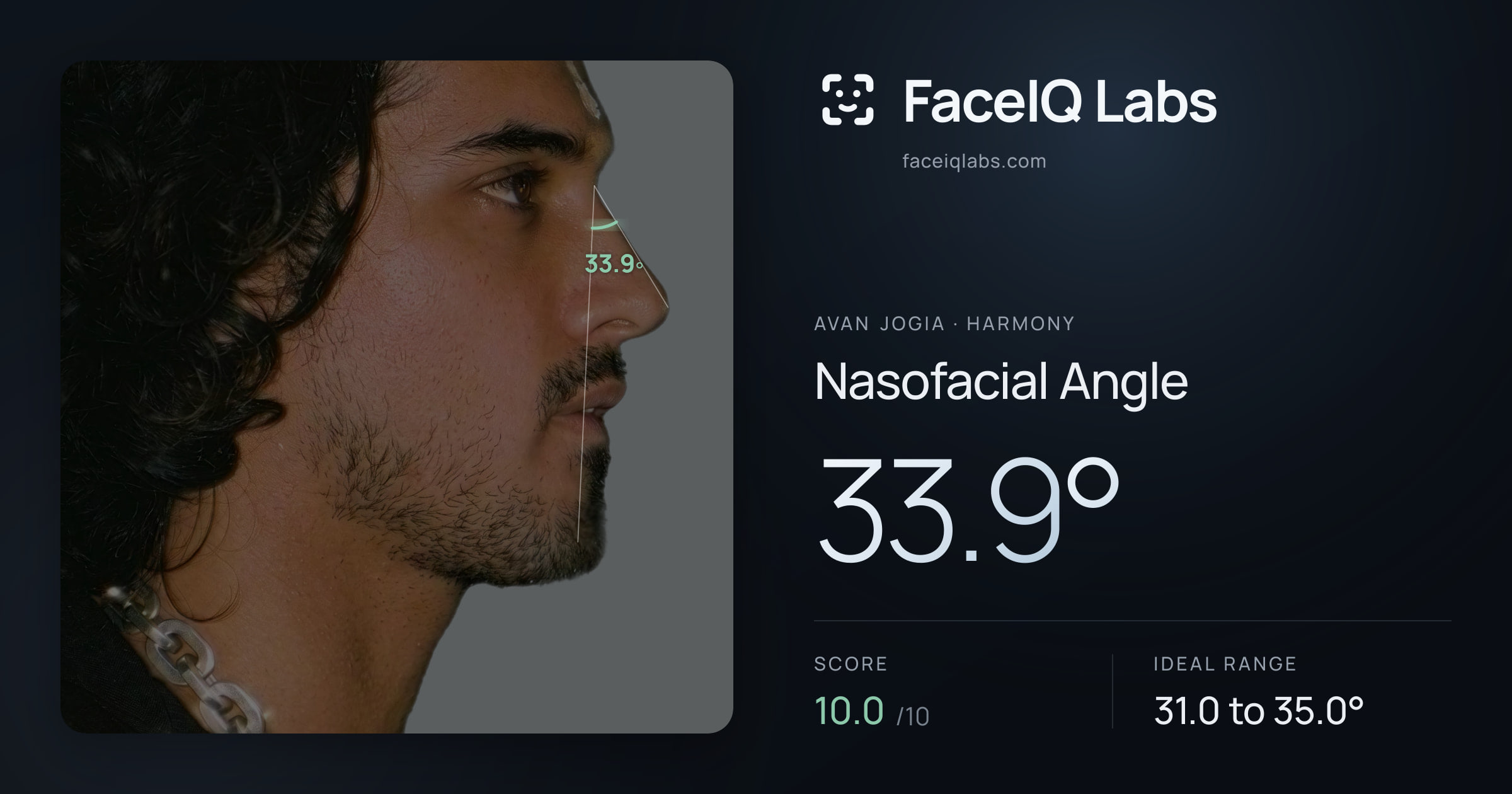 Avan Jogia Nasofacial Angle: 33.9°, drawn on the photo