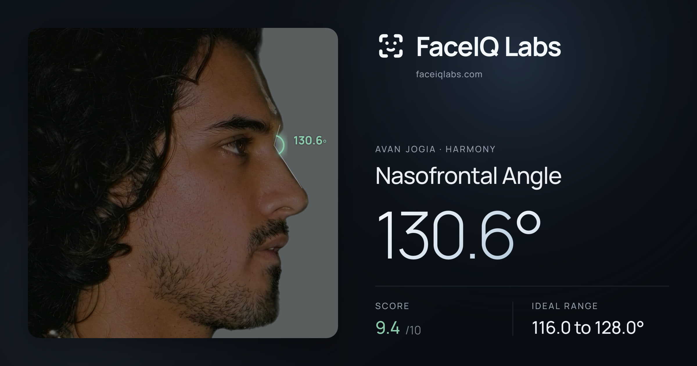 Avan Jogia Nasofrontal Angle: 130.6°, drawn on the photo