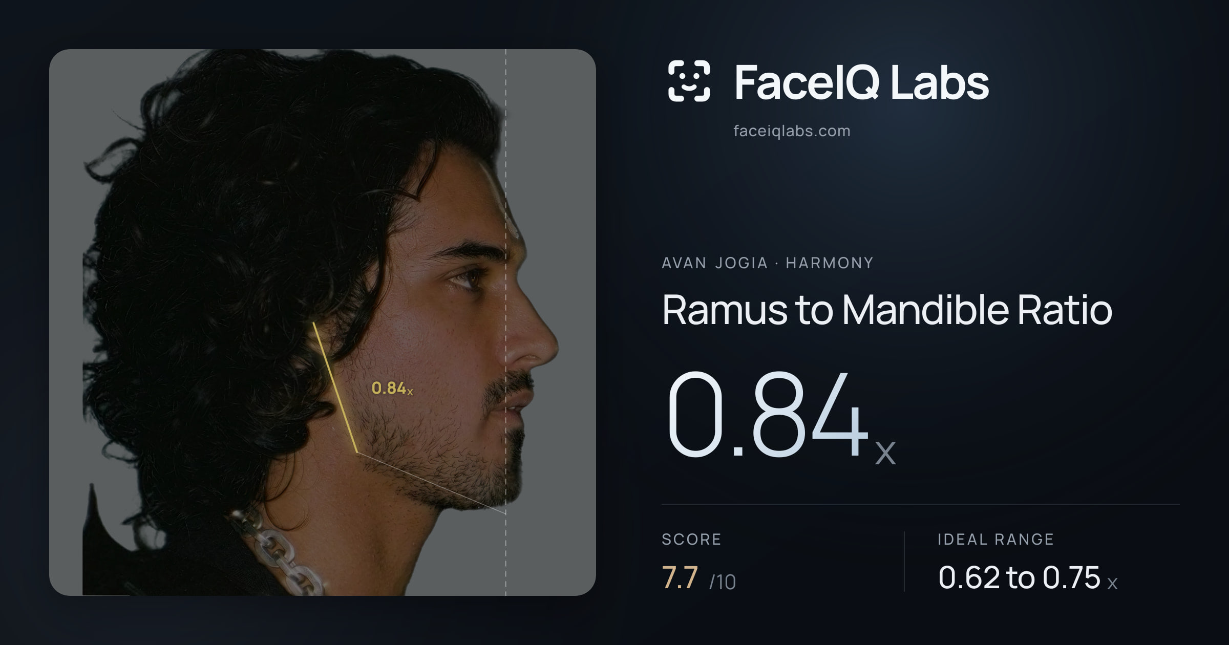 Avan Jogia Ramus to Mandible Ratio: 0.84x, drawn on the photo