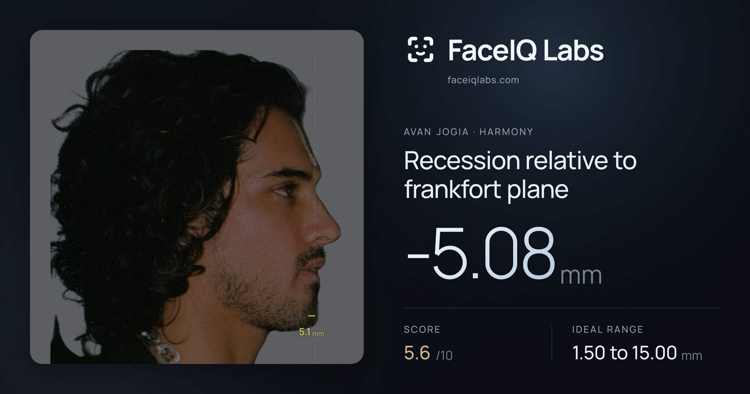 Avan Jogia Recession relative to frankfort plane: -5.08mm, drawn on the photo