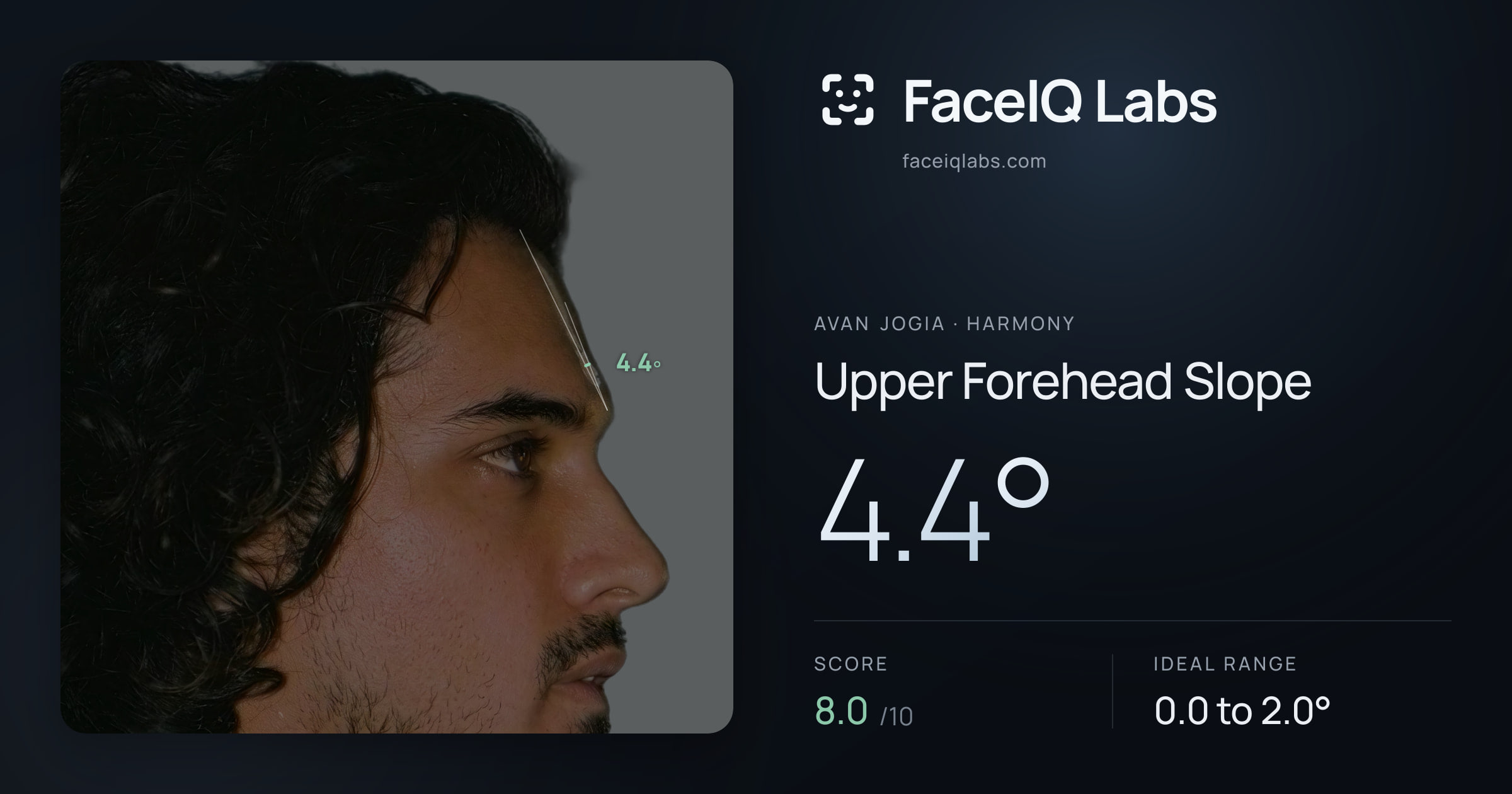 Avan Jogia Upper Forehead Slope: 4.4°, drawn on the photo
