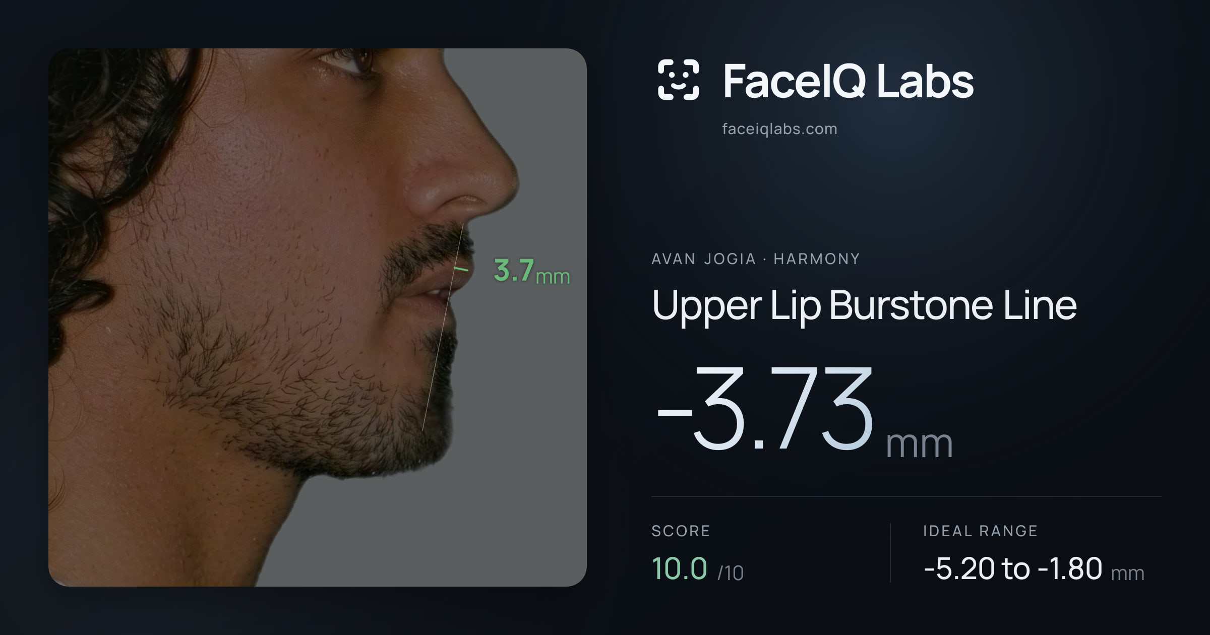 Avan Jogia Upper Lip Burstone Line: -3.73mm, drawn on the photo